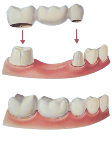 Replace missing teeth to improve the appearance and function of the mouth