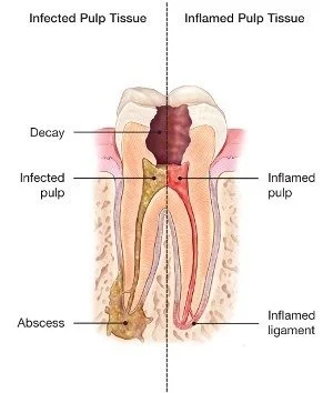 Endodontists perform root canal therapy to remove infected or damaged pulp tissue from the tooth.