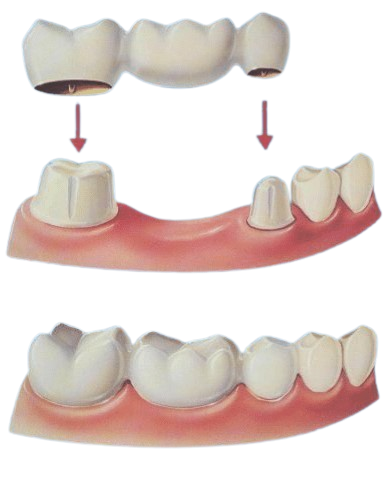 Brushing and flossing, can help prevent cavities from forming in the first place.