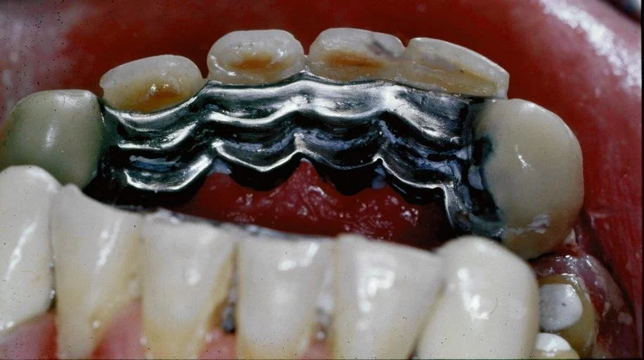 A dental bridge is a device used to replace one or more missing teeth.