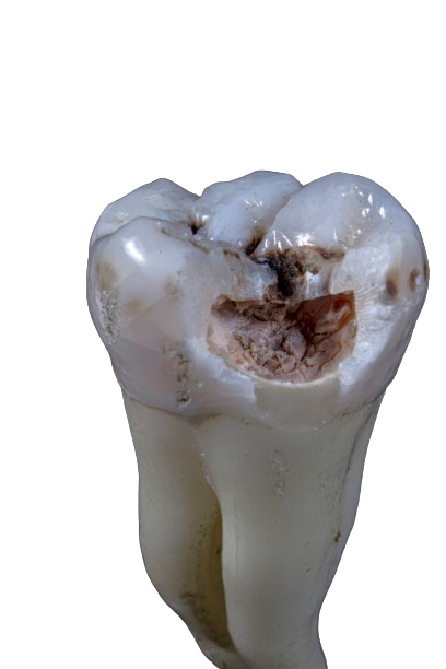 The pulp which is the soft tissue inside the root canal,