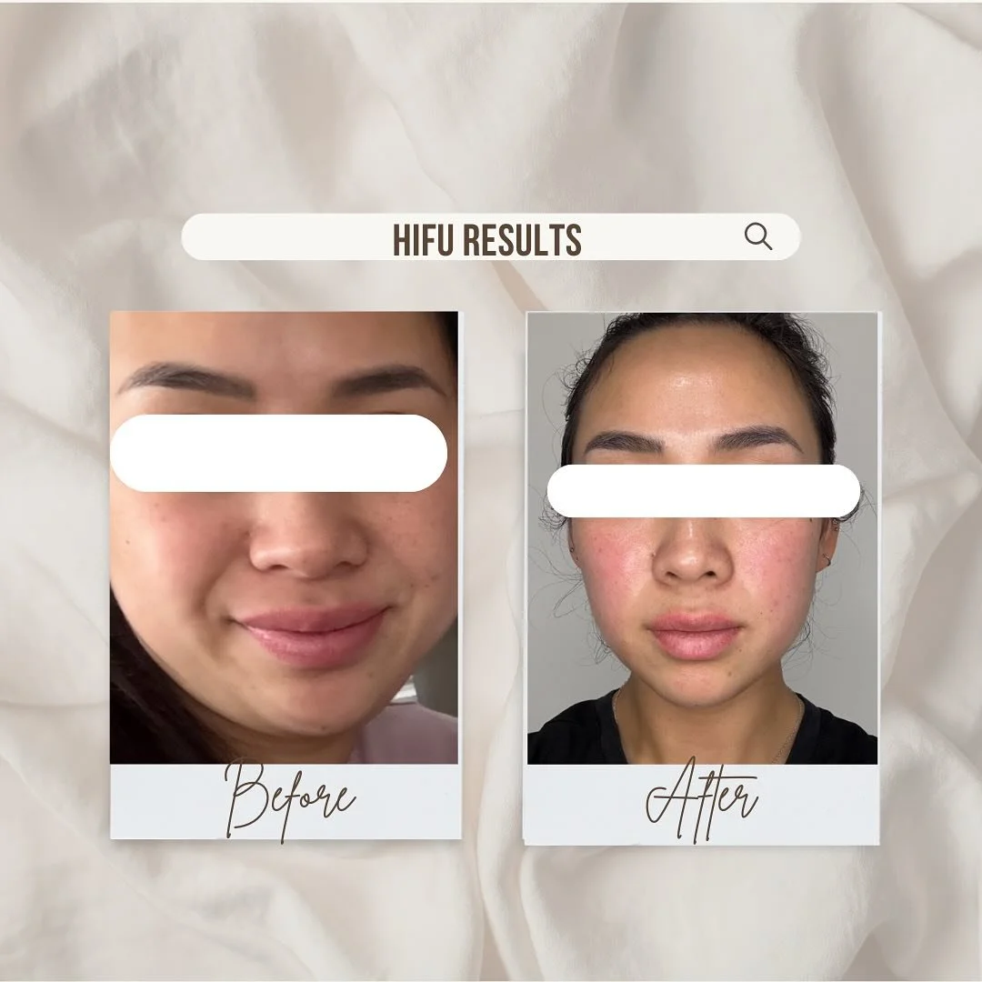 We love a snatched jawline 😍 

Say goodbye to your double chin and fine lines and wrinkles on your face. HIFU helps to lift, tighten and define the structure of your face! 

DM us for all bookings and enquiries. #hifu #hifufacial #hifu7d #hifutreatm