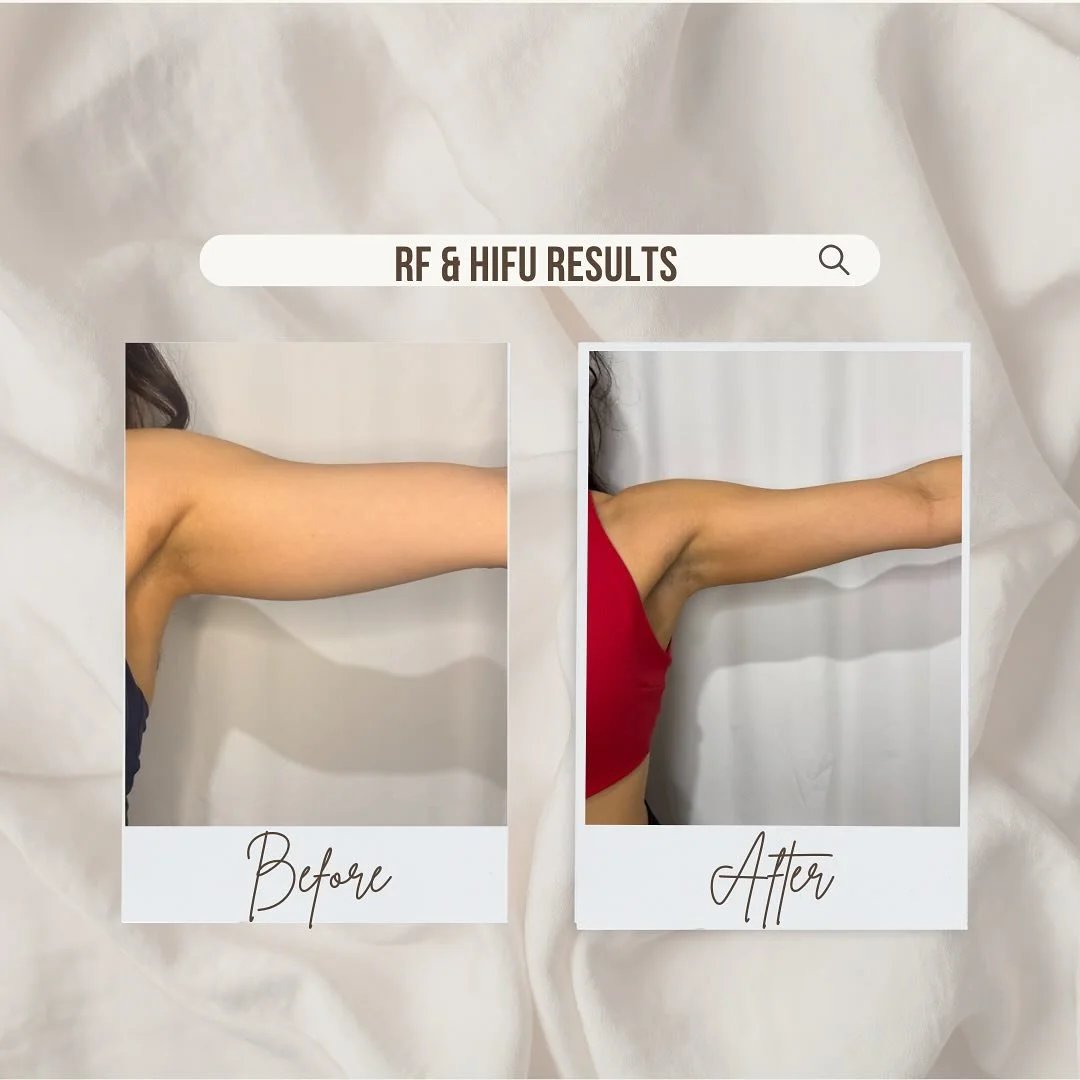 Do you want toner, slimmer and more defined arms?  This is a before and after photo of our client after 4x RF and 1x HIFU session. Combining treatments like RF and HIFU help optimise your results of having toned and slimmer arms. 
Arm fat and sagging