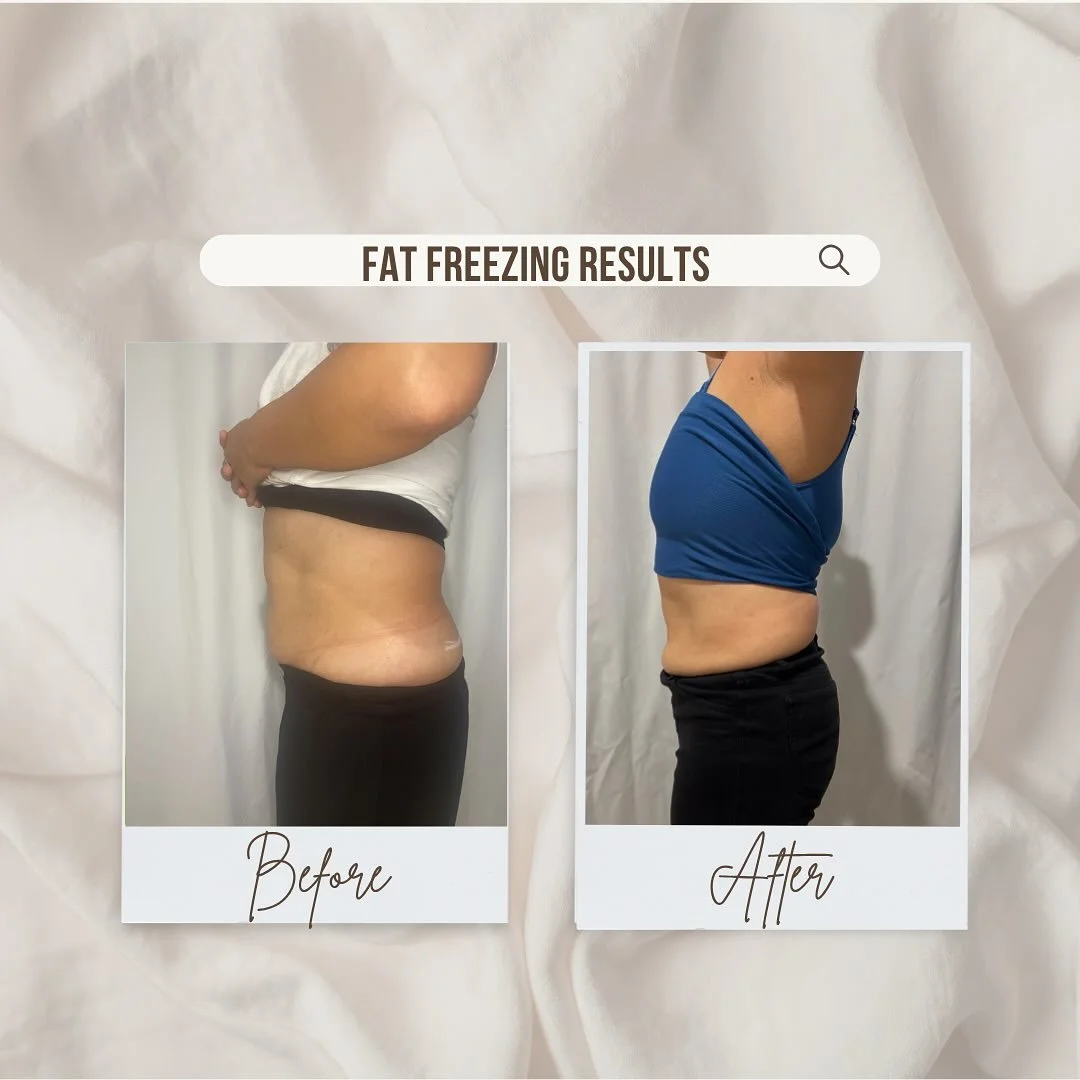 ✨ Real Results ✨
Our client is glowing with confidence after just 2 sessions of fat freezing! ❄️💪

📍 Targeted fat reduction
⏳ Non-invasive &amp; no downtime
🔥 Sculpted, smoother contours

Ready for your transformation?
👉 DM us or click the link i