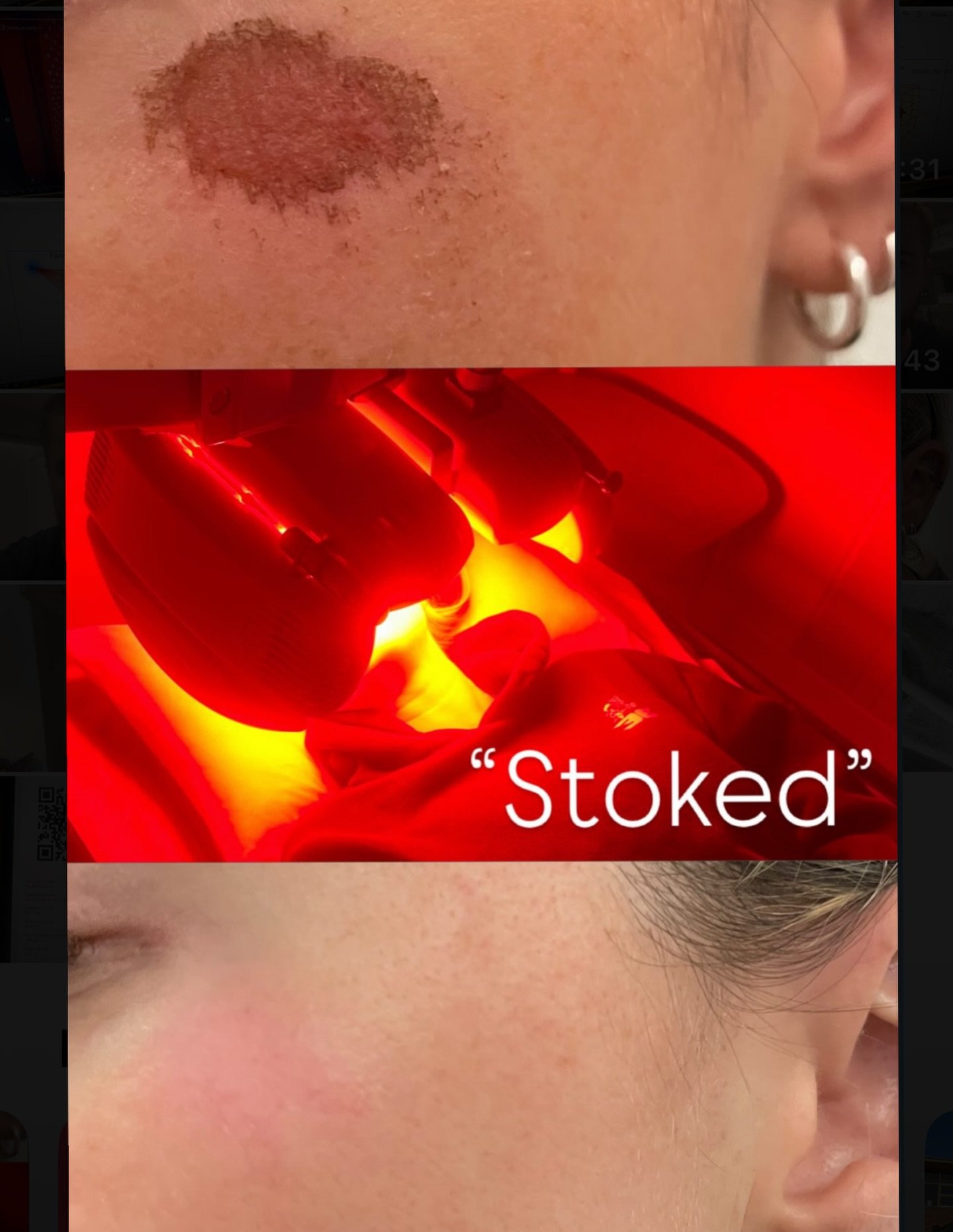 5 sessions in 6 days and it&rsquo;s disappeared like magic thanks to Dermalux TriWave only @healing_on_spring

Don&rsquo;t let an accidental fall, keep you indoors any longer. Works fantastic as well for pre and post surgery!