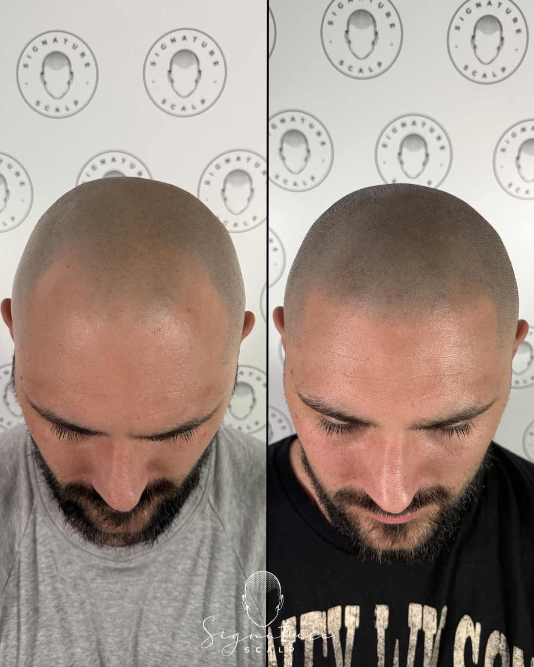 Scalp micropigmentation before and after result at Signature Scalp Marden Adelaide