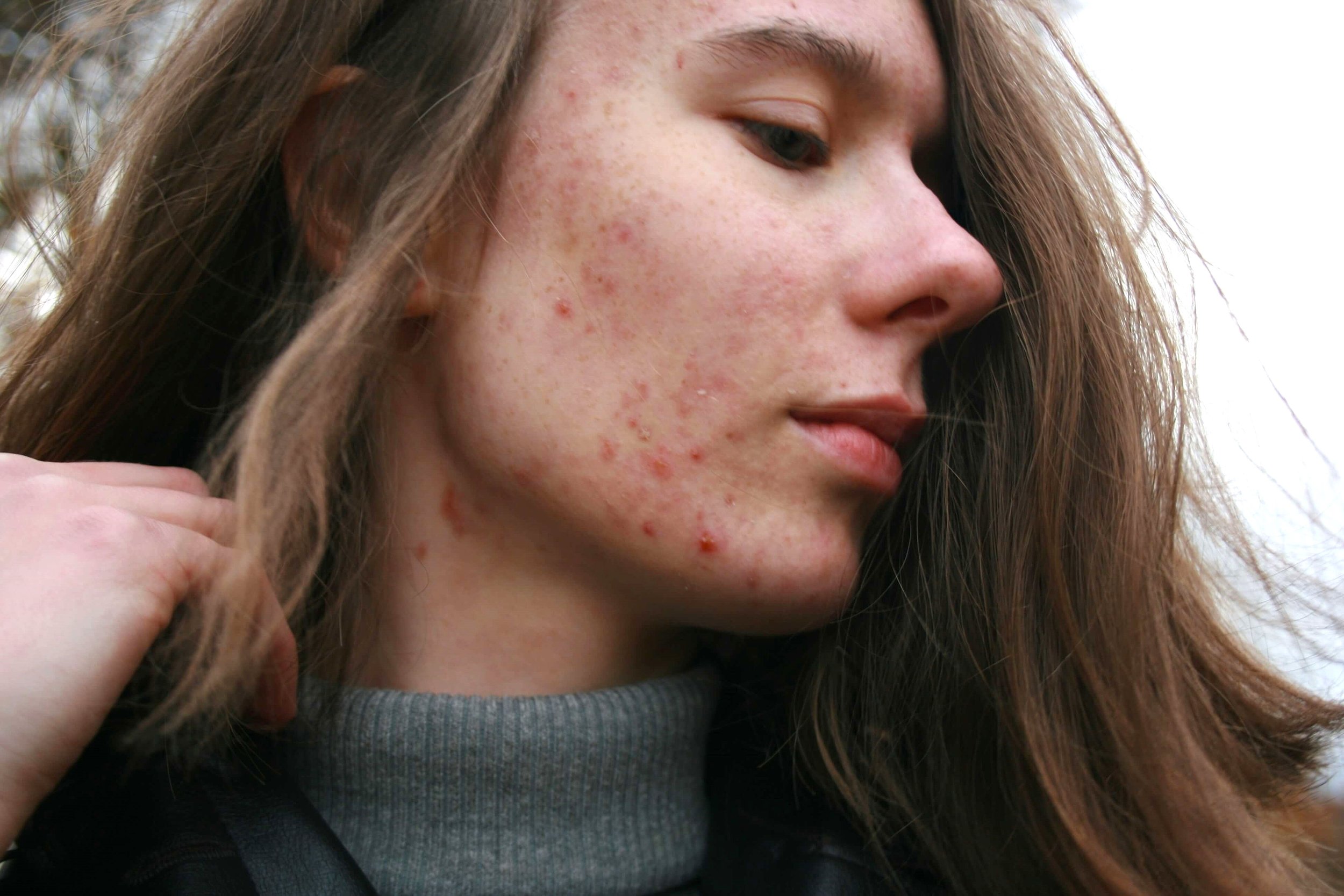 Young woman with facial acne