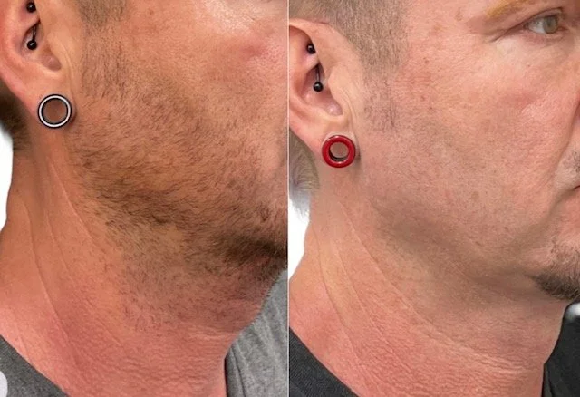 Étoile Aesthetics SD | San Diego | Comparison of a man's facial skin before and after beard grooming or treatment, showing smoother skin on the right.