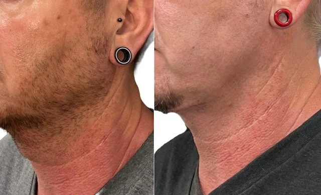 Étoile Aesthetics SD | San Diego | Close-up of two men's necks with red and black ear gauges, and visible scar tissue on one neck