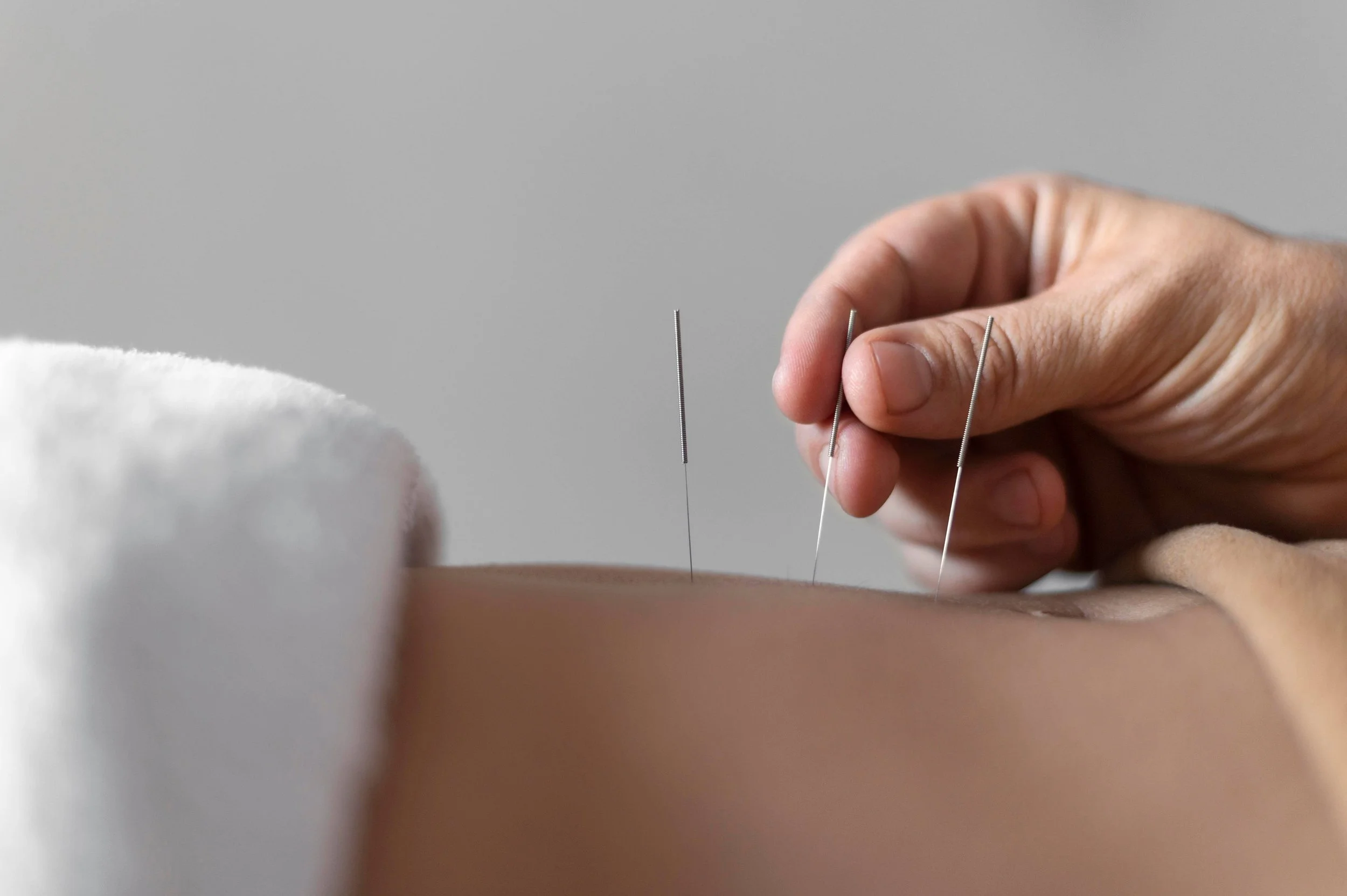 Does Acupuncture Help with IVF Success Rates?