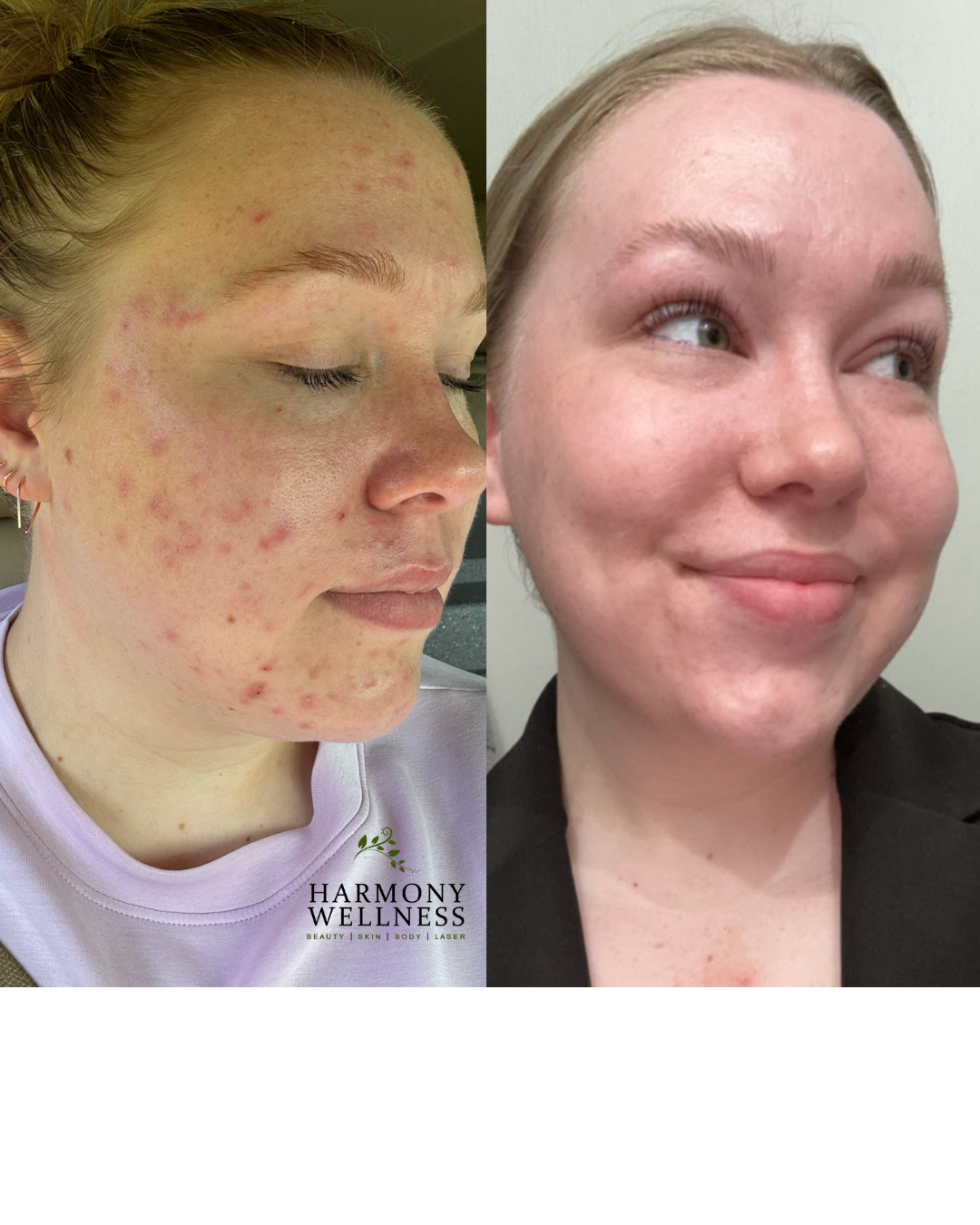 Clear Skin Starts Here: Celebrating Acne Awareness Month atHarmony Wellness