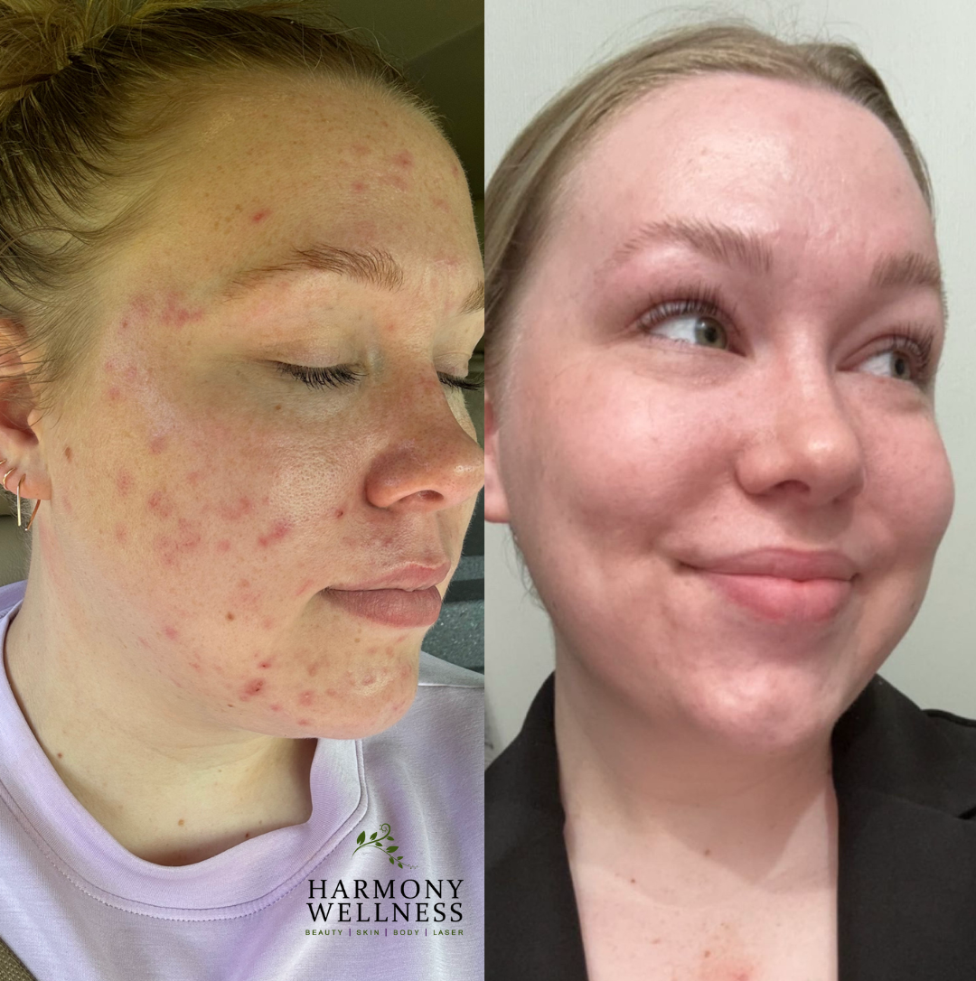 Clear Skin Starts Here: Celebrating Acne Awareness Month