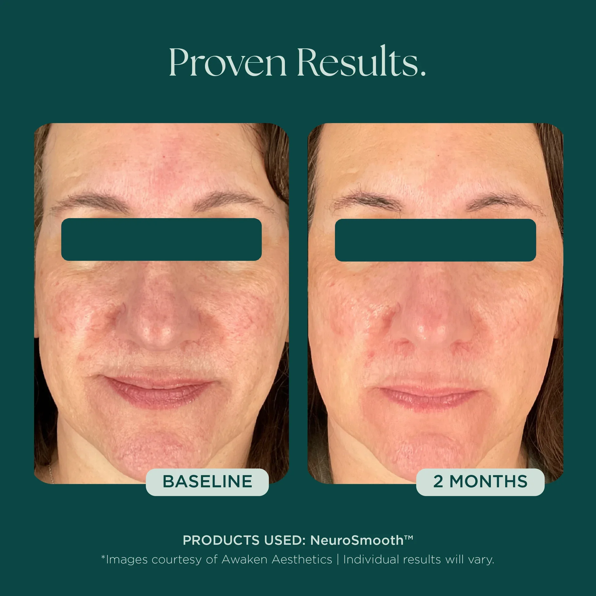 MSS26_Shopify_ProductPage_Before_Afters_FineLines_Wrinkles_042726__WRINKLES-NeuroSmooth-5.jpg.webp