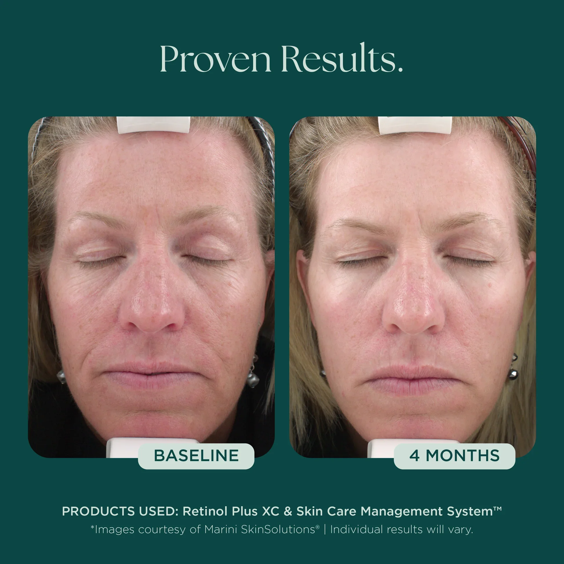 MSS26_Shopify_ProductPage_Before_Afters_FineLines_Wrinkles_042726__WRINKLES-8002.jpg.webp