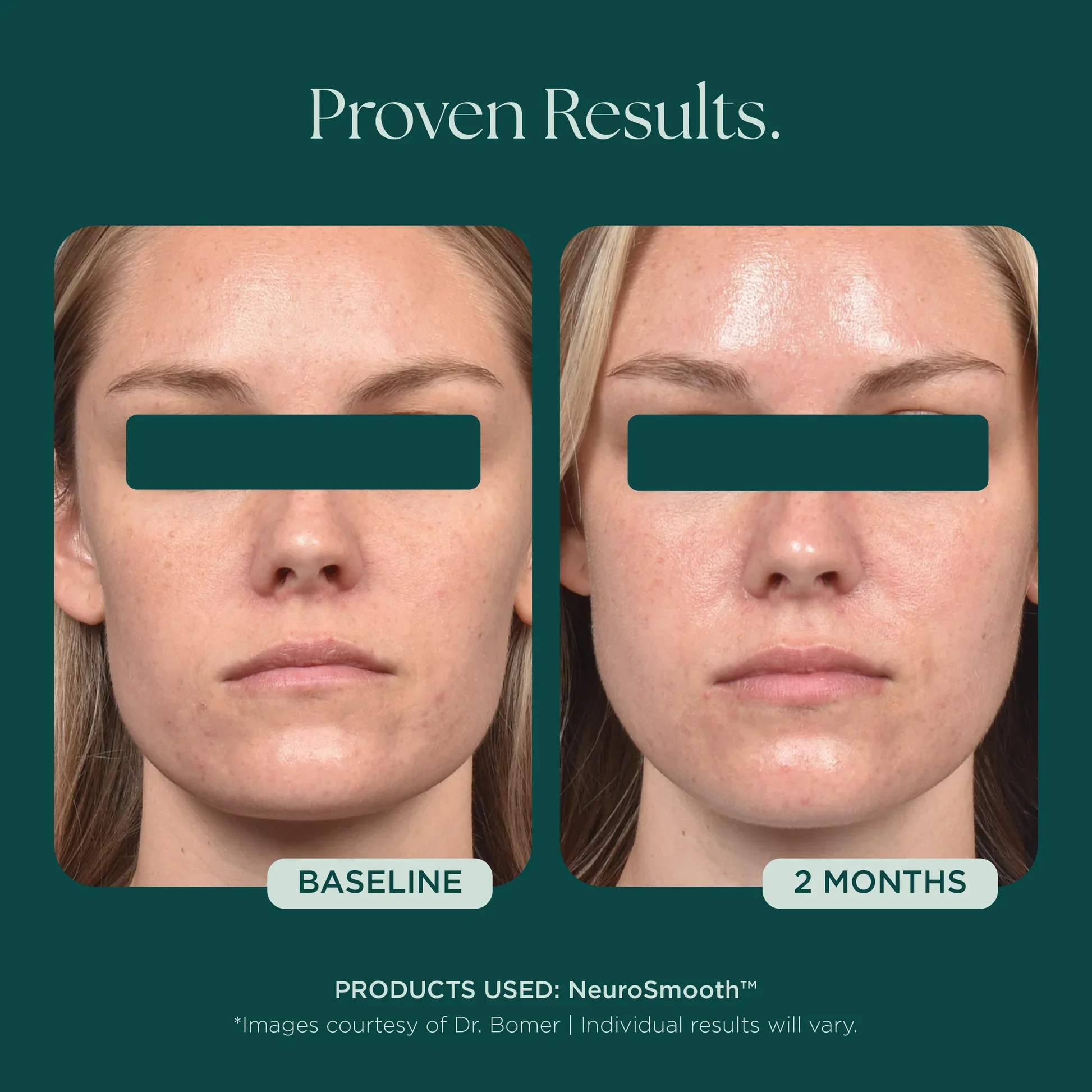 MSS26_Shopify_ProductPage_Before_Afters_FineLines_Wrinkles_042726__WRINKLES-NeuroSmooth-2.jpg.webp