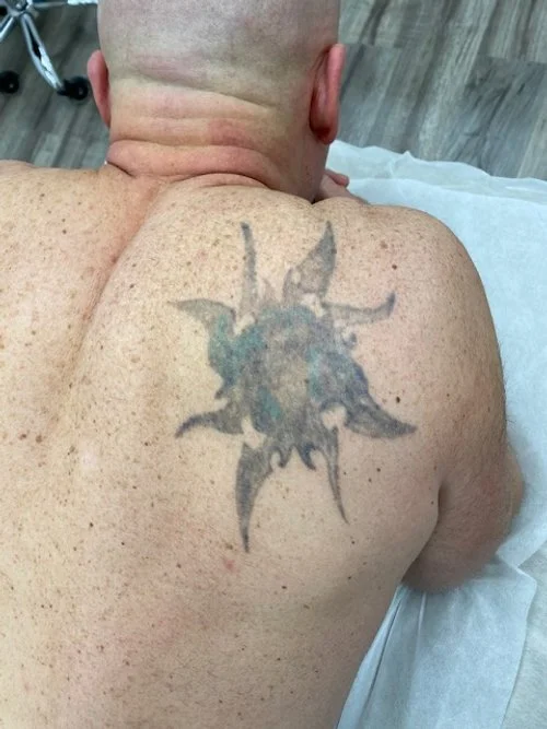 A man with a tattoo of a sun design on his shoulder, seen from behind, lying on a medical bed.
