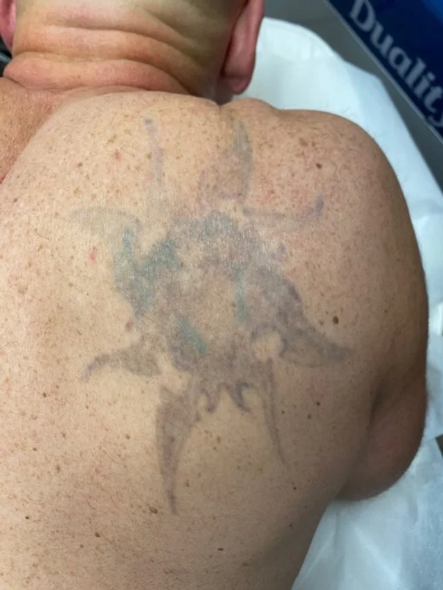 A person's back with a large tattoo of a star-shaped symbol or figure that appears faded or partially healed.