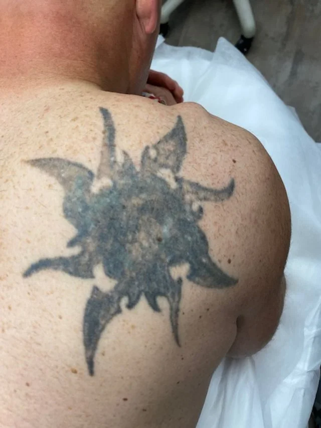 Close-up of a person's shoulder with a large, faded black tattoo of a spiky, star-shaped design.