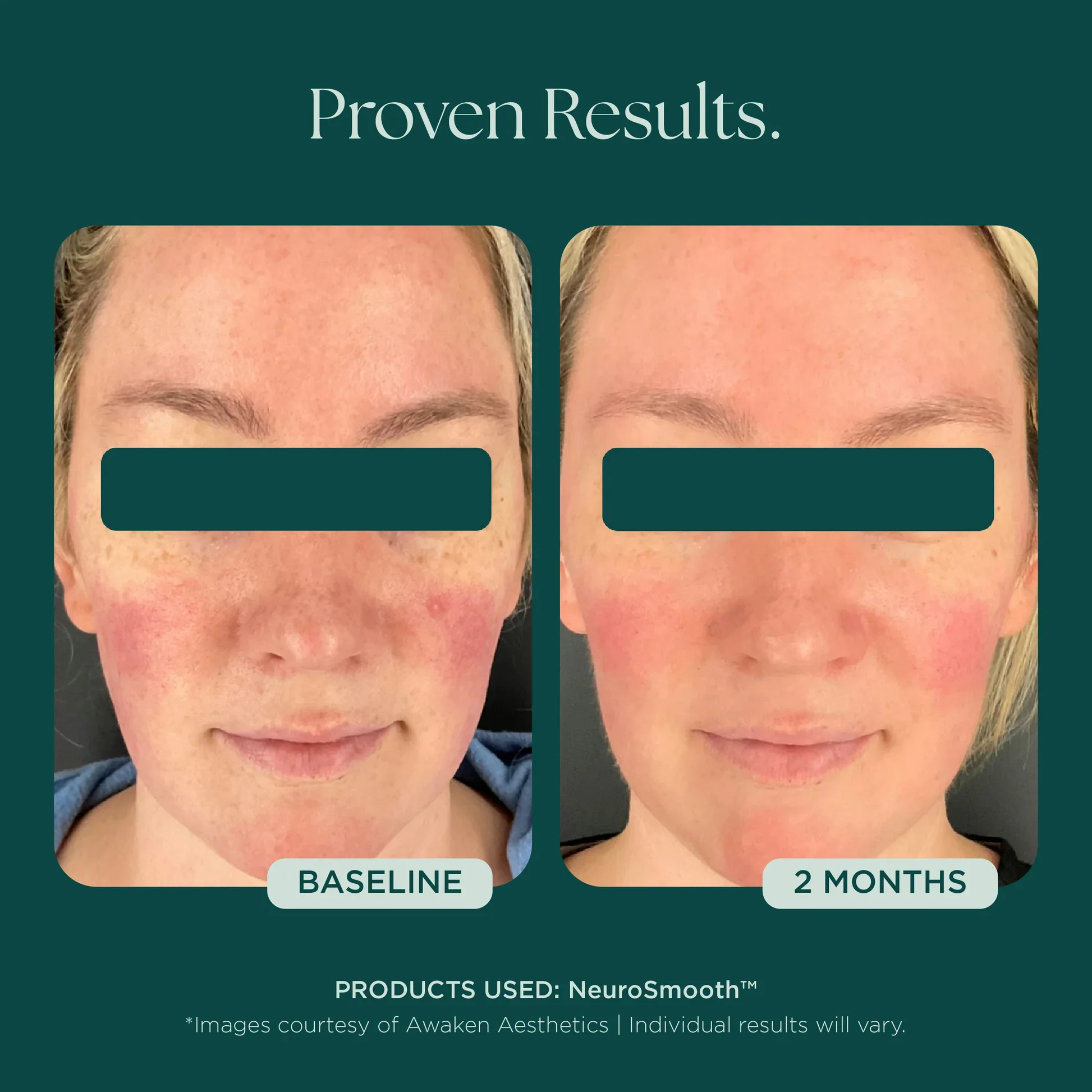 MSS26_Shopify_ProductPage_Before_Afters_FineLines_Wrinkles_042726__WRINKLES-NeuroSmooth-4.jpg.webp