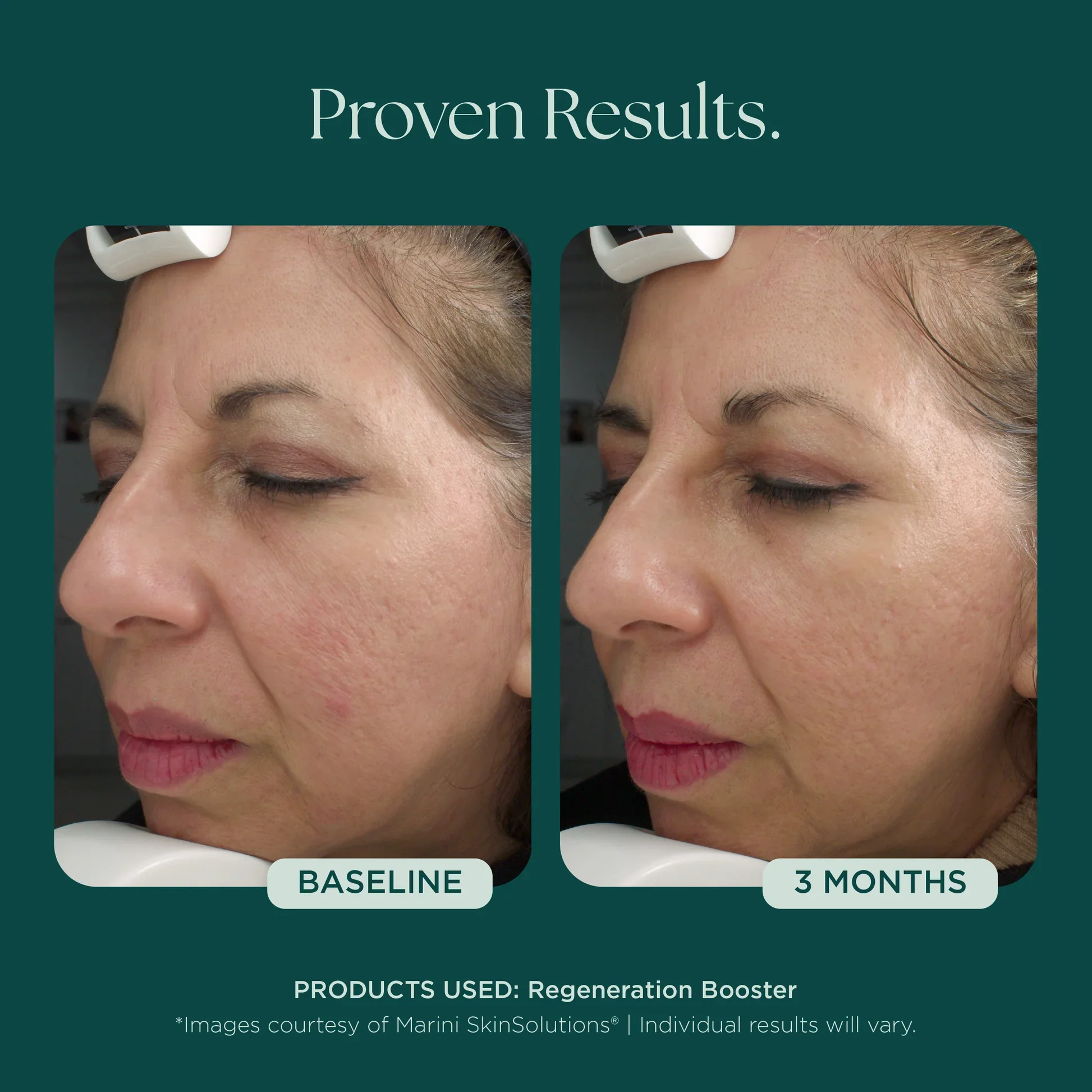 MSS26_Shopify_ProductPage_Before_Afters_FineLines_Wrinkles_042726__WRINKLES-Booster.jpg.webp