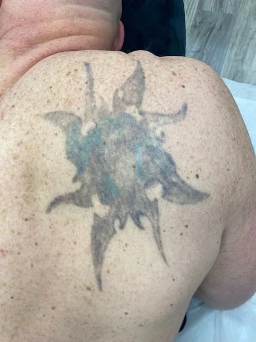A tattoo of a stylized, spiky, dark-colored creature or design on a person's upper back.