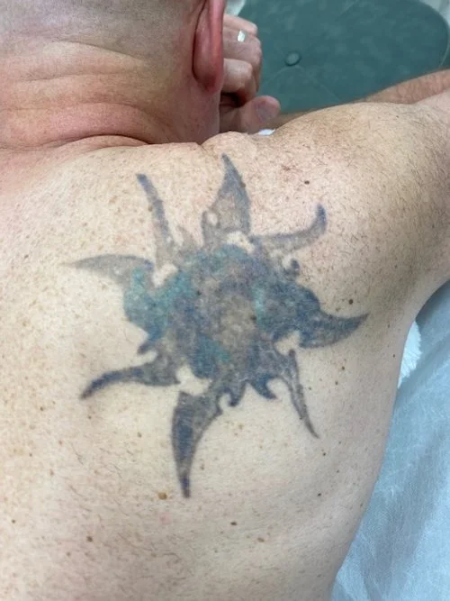 A close-up of a person's shoulder and back with a tattoo of a star-shaped, spiky design on the skin.