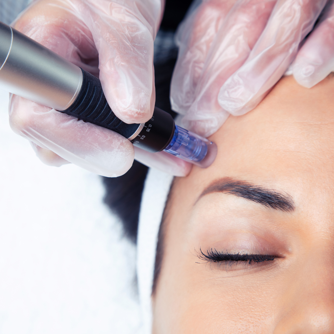 microneedleing post.png