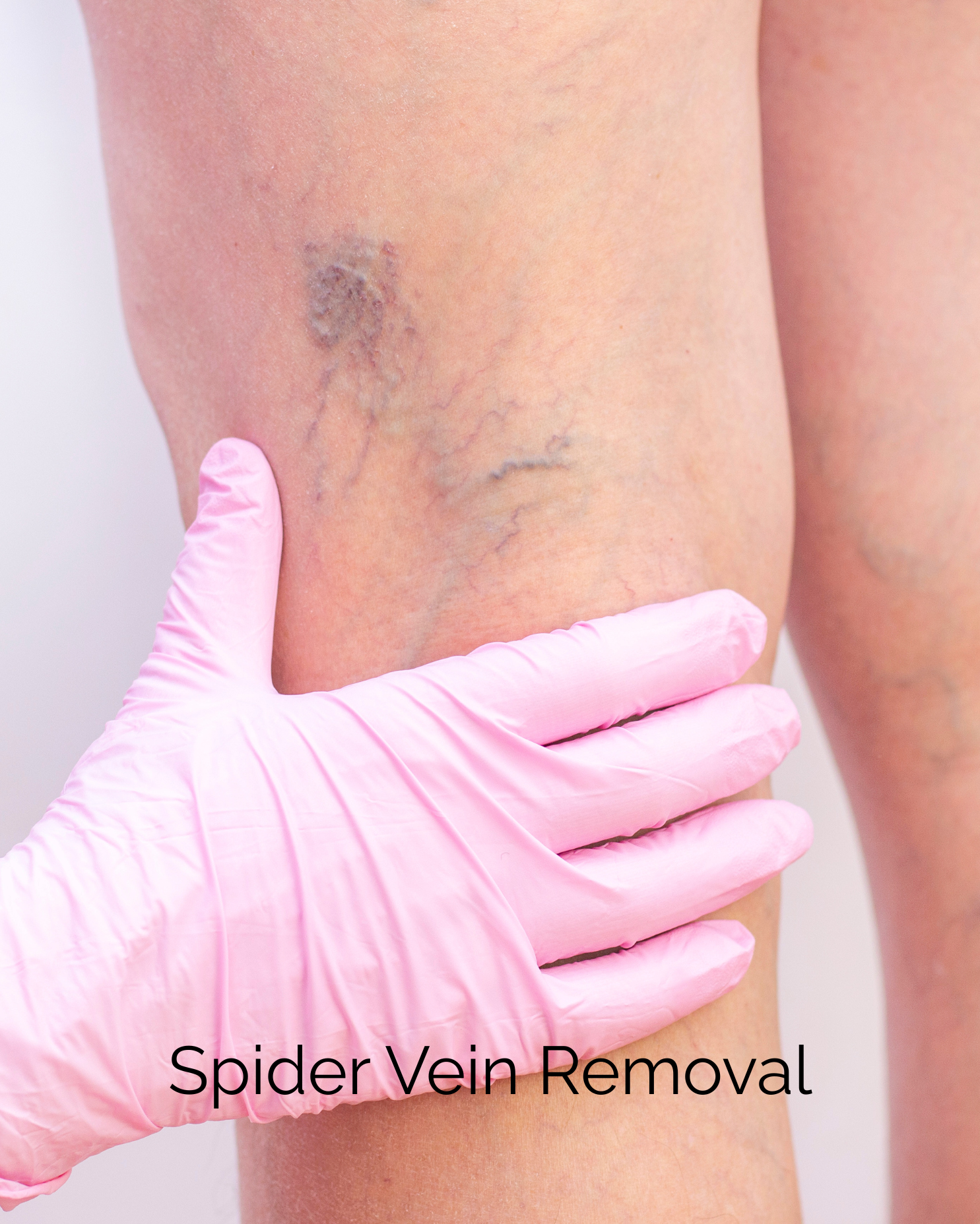 Spider Vein Removal