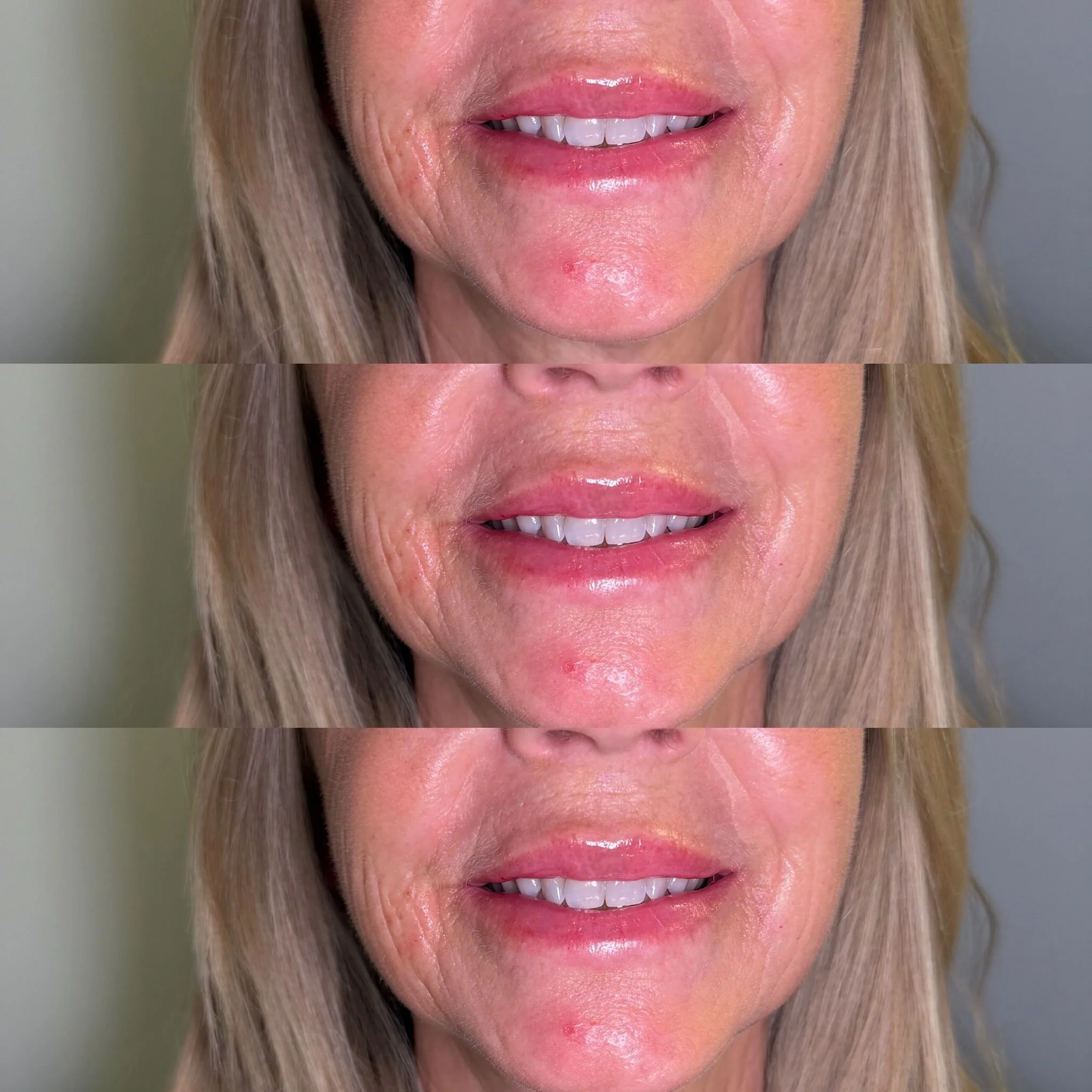 Your lip goals deserve more than a saved inspo photo. 💋 Let&rsquo;s talk shape, volume, and a treatment plan personalized to you. DM &ldquo;LIPS&rdquo; to book your consultation!

Xoxo,
Ashley💉✨

📞 (850) 276-5161

📍 8317 Front Beach Rd. Unit 34D,