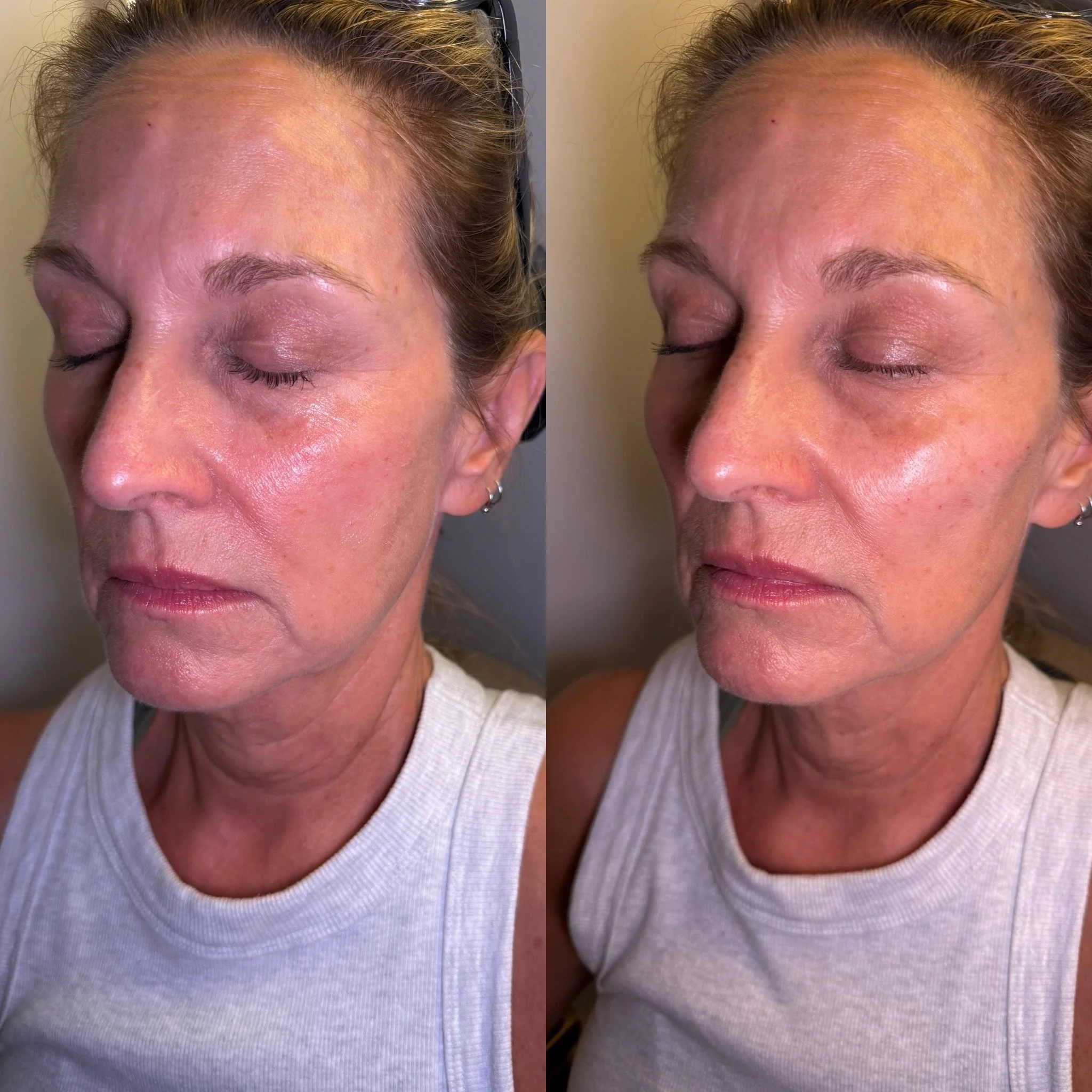 A little volume, a beautiful difference. Cheek filler to enhance her natural contours and bring definiton to her cheeks. Are you curious what cheek filler could do for you?  Message us to find out. 

 Xoxo,
Ashley💉✨

📞 (850) 276-5161

📍 8317 Front