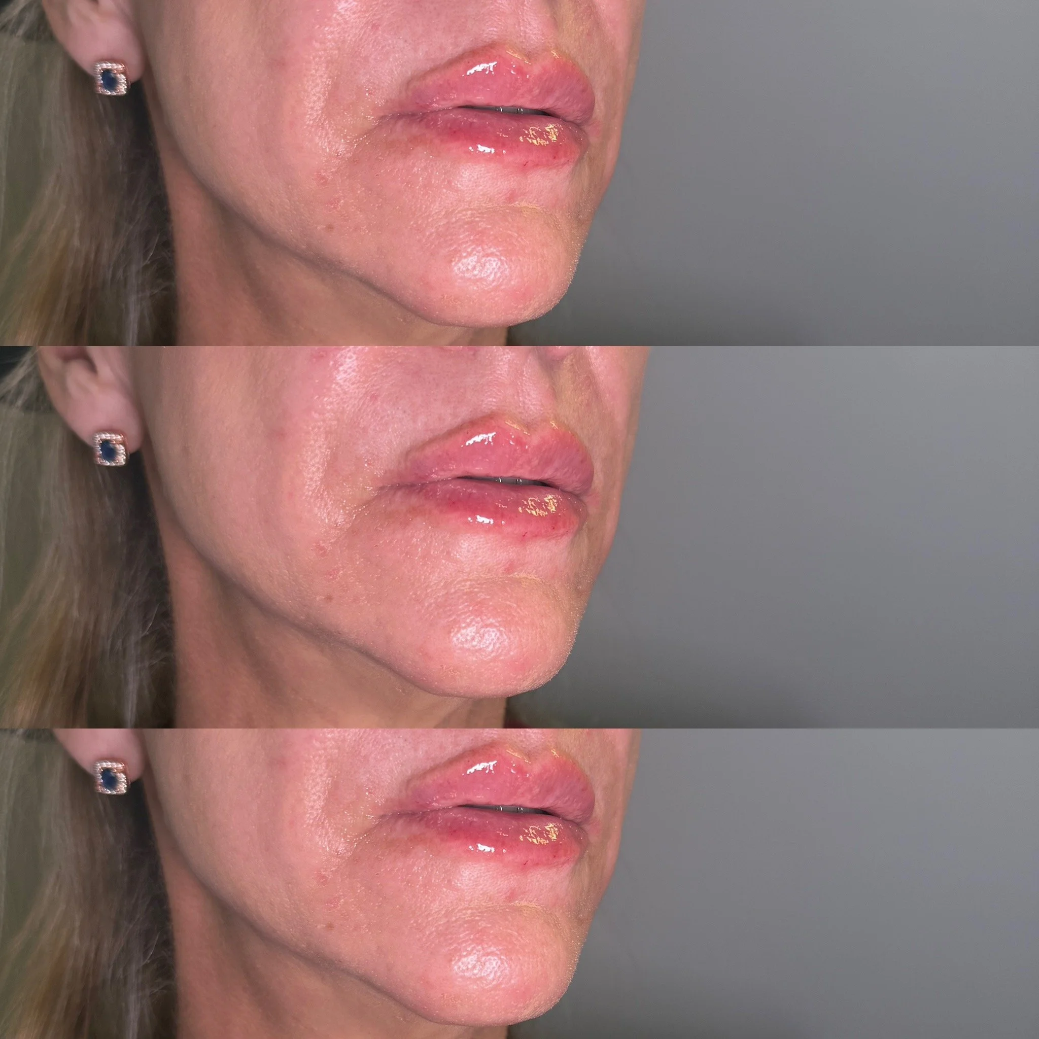 Lip filler is customized to your natural shape, proportions, and goals. Whether you're looking for more definition, improved symmetry, or a subtle boost in volume, your treatment plan is designed specifically for YOU.

Xoxo,
Ashley💉✨

📞 (850) 276-5