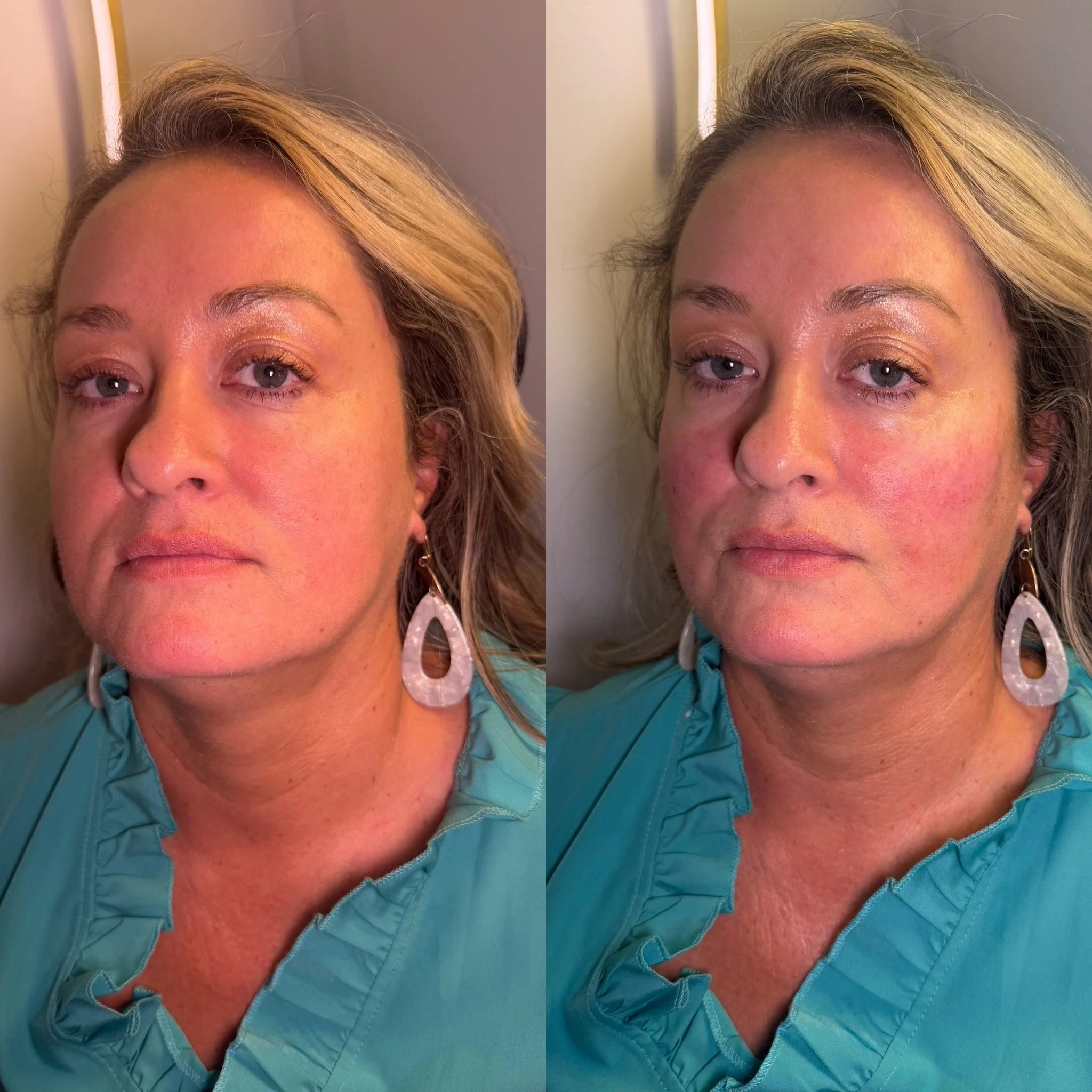 Want a little more lift, definition, and structure? Cheek filler can make ALL the difference.

The right placement can enhance your cheekbones, restore lost volume, and create a more lifted, refreshed appearance without looking overdone. 

Your facia