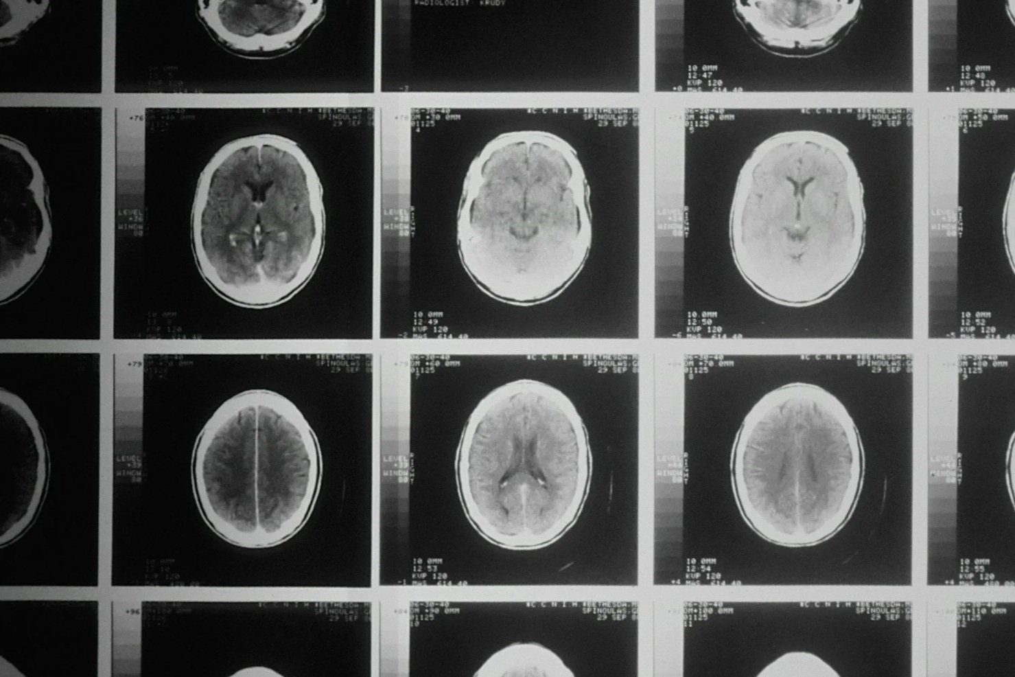 Rehabilitación neuropsicológica de lesiones cerebrales adquiridas