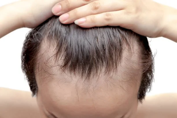 Hair Loss or Hair Thinning Can Be Frustrating