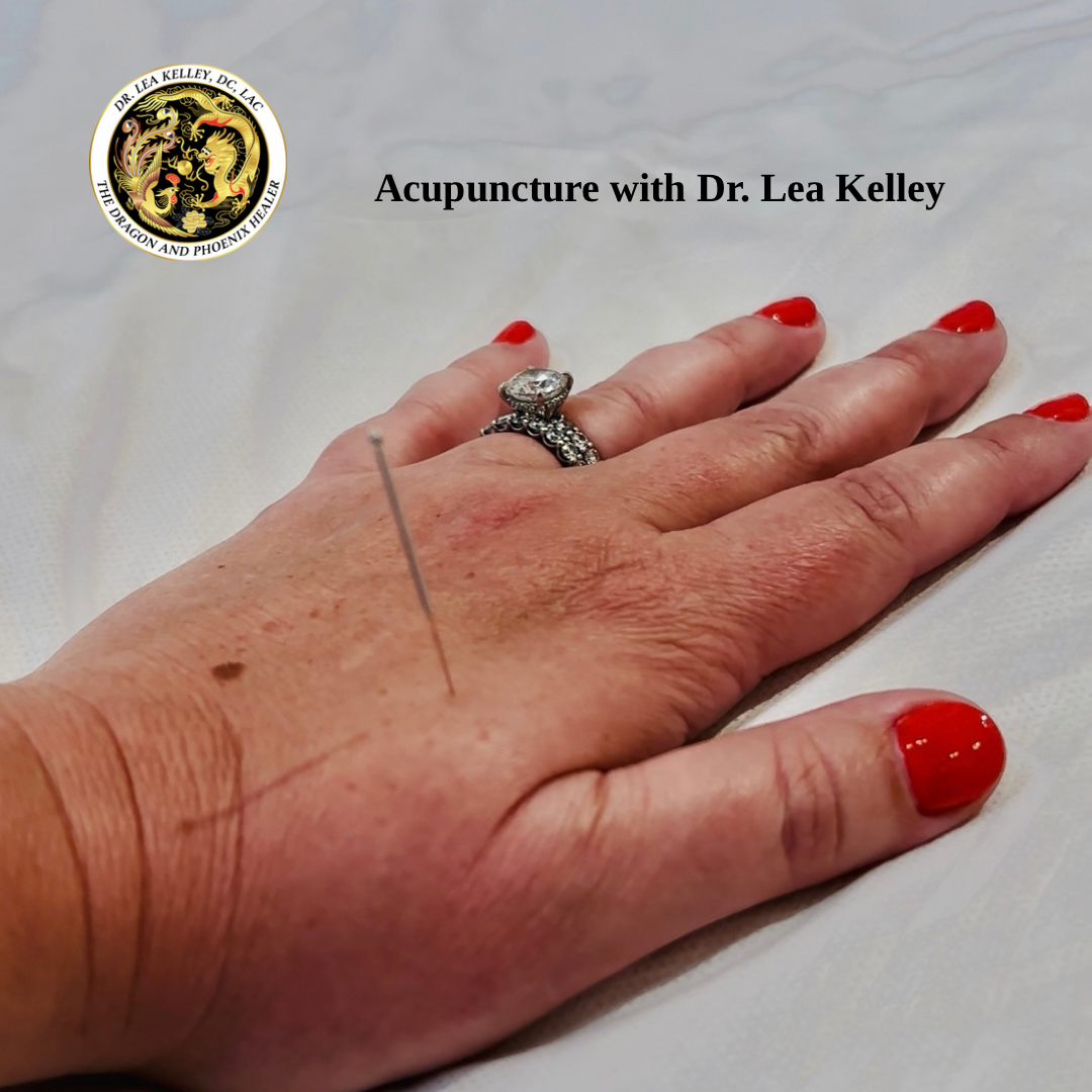 Picture of a woman's hand with an acupuncture needle on her left hand.