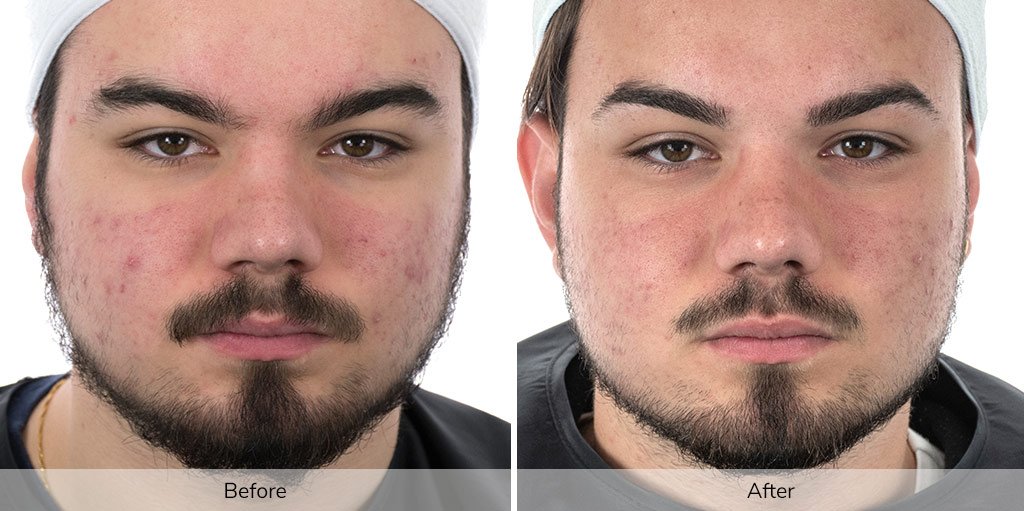 Before and after results from the Elevare Ivory Advanced Skin Rejuvenation Facial showing improvement in acne-prone skin and overall complexion.