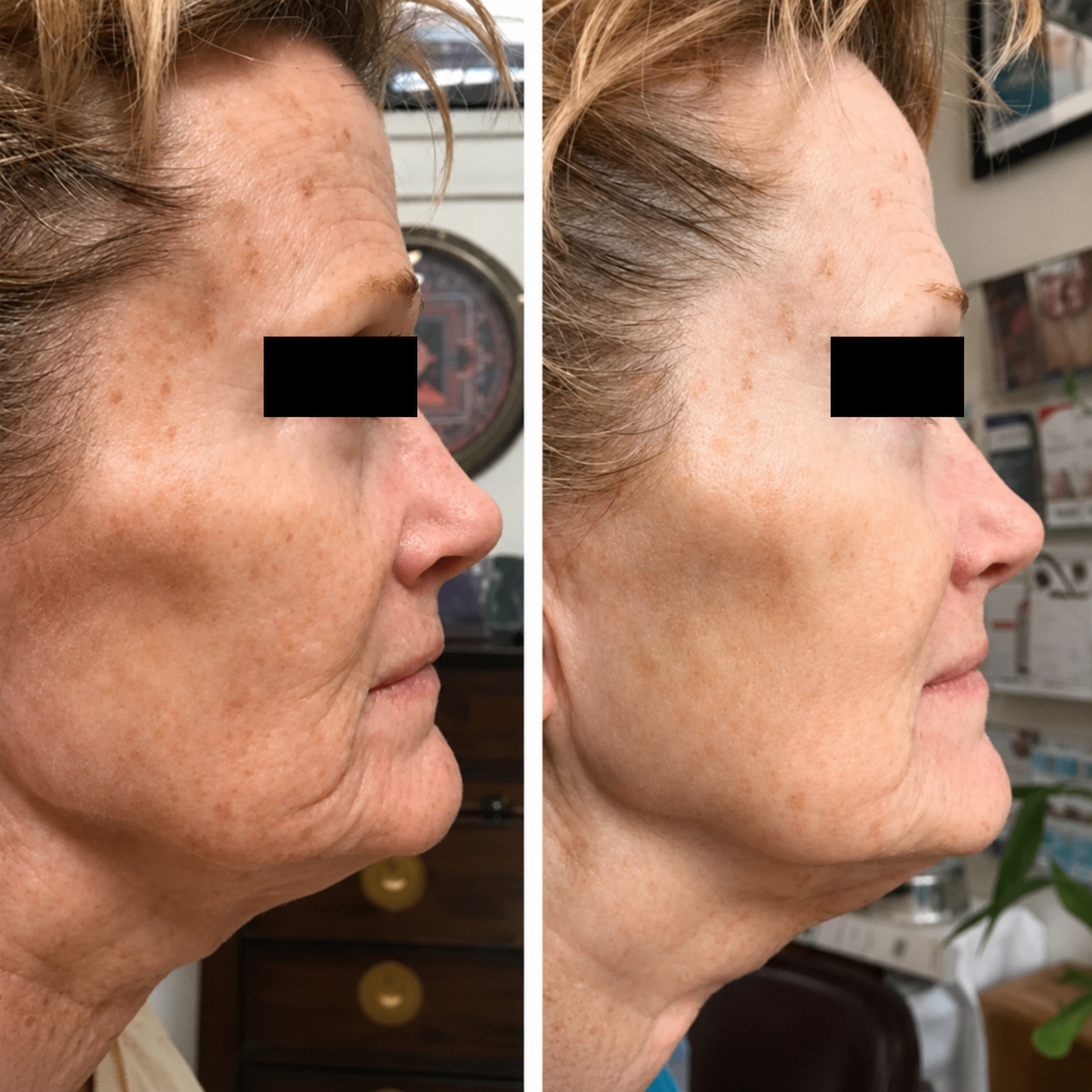 Before-and-after images showing improvement in skin firmness, facial contours, fine lines, and overall skin rejuvenation following an Advanced Skin Rejuvenation Facial