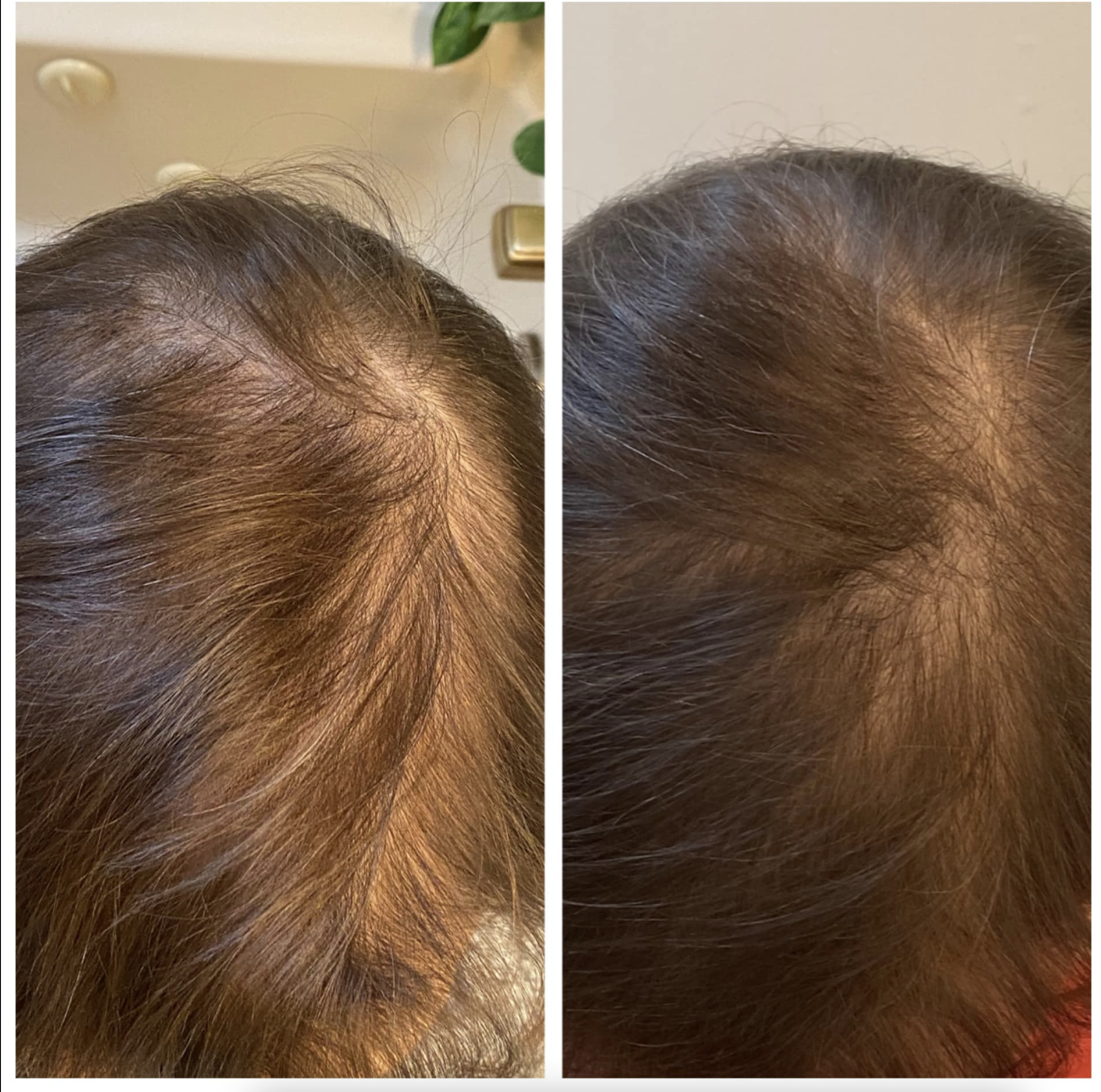 Before and after scalp microneedling for hair restoration showing improved hair density and reduced hair thinning by Dr. Lea Kelley in Manhattan Beach, CA