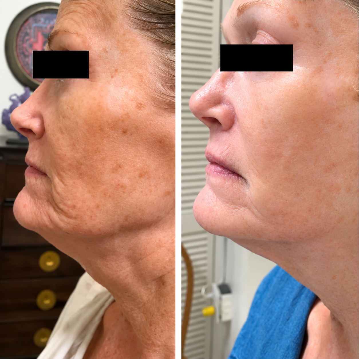 Before-and-after-images showing improved skin tone, texture, and the appearance of facial wrinkles after a small series of Advanced Skin Rejuvenation Facial treatments.