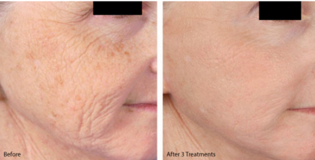 Before and after three medical-grade microneedling treatment showing improved skin texture, reduced fine lines, and smoother facial skin by Dr. Lea Kelley in Manhattan Beach
