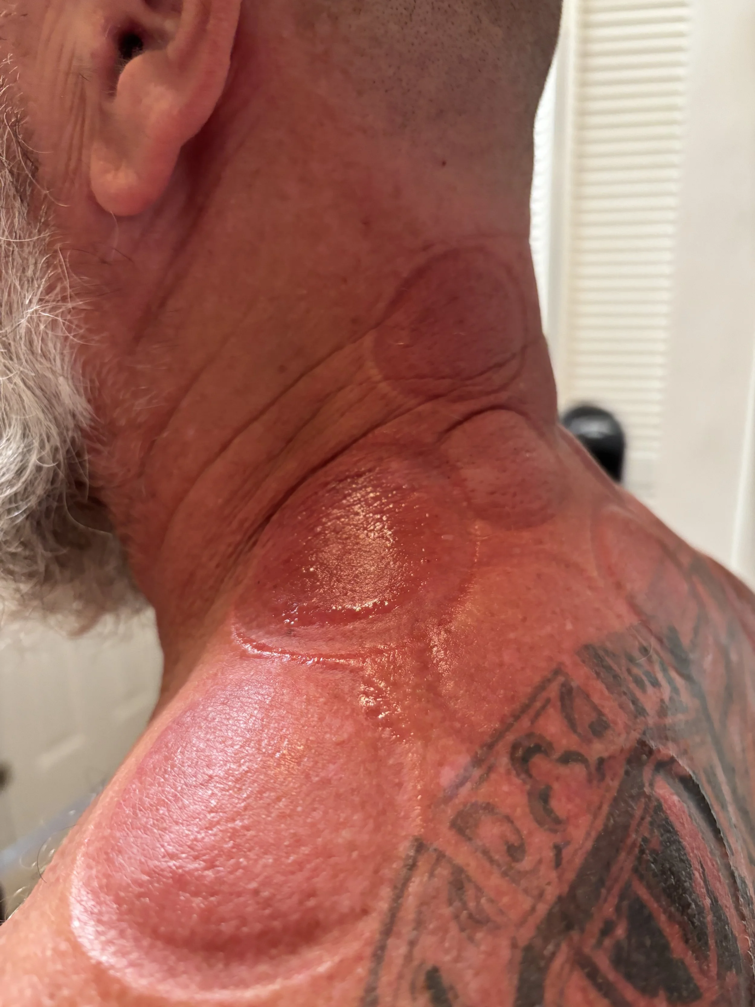 Circular cupping marks on patient's neck and shoulder following cupping therapy with Dr. Lea Kelley