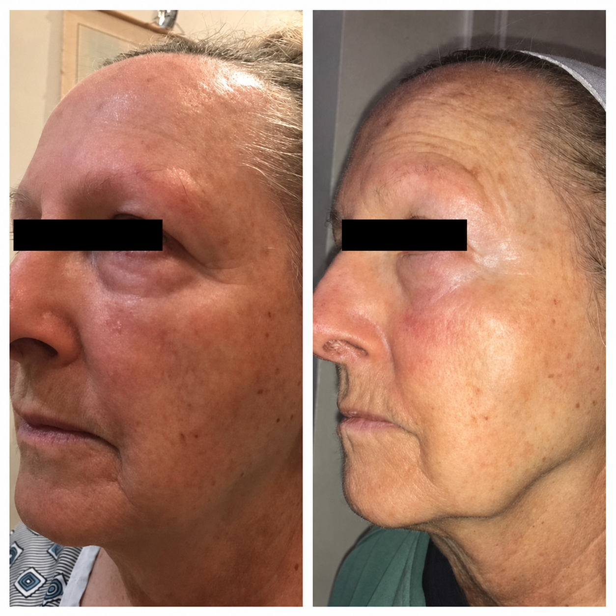 Before and after only one medical-grade microneedling treatment showing improved skin texture, reduced fine lines, and smoother facial skin by Dr. Lea Kelley in Manhattan Beach