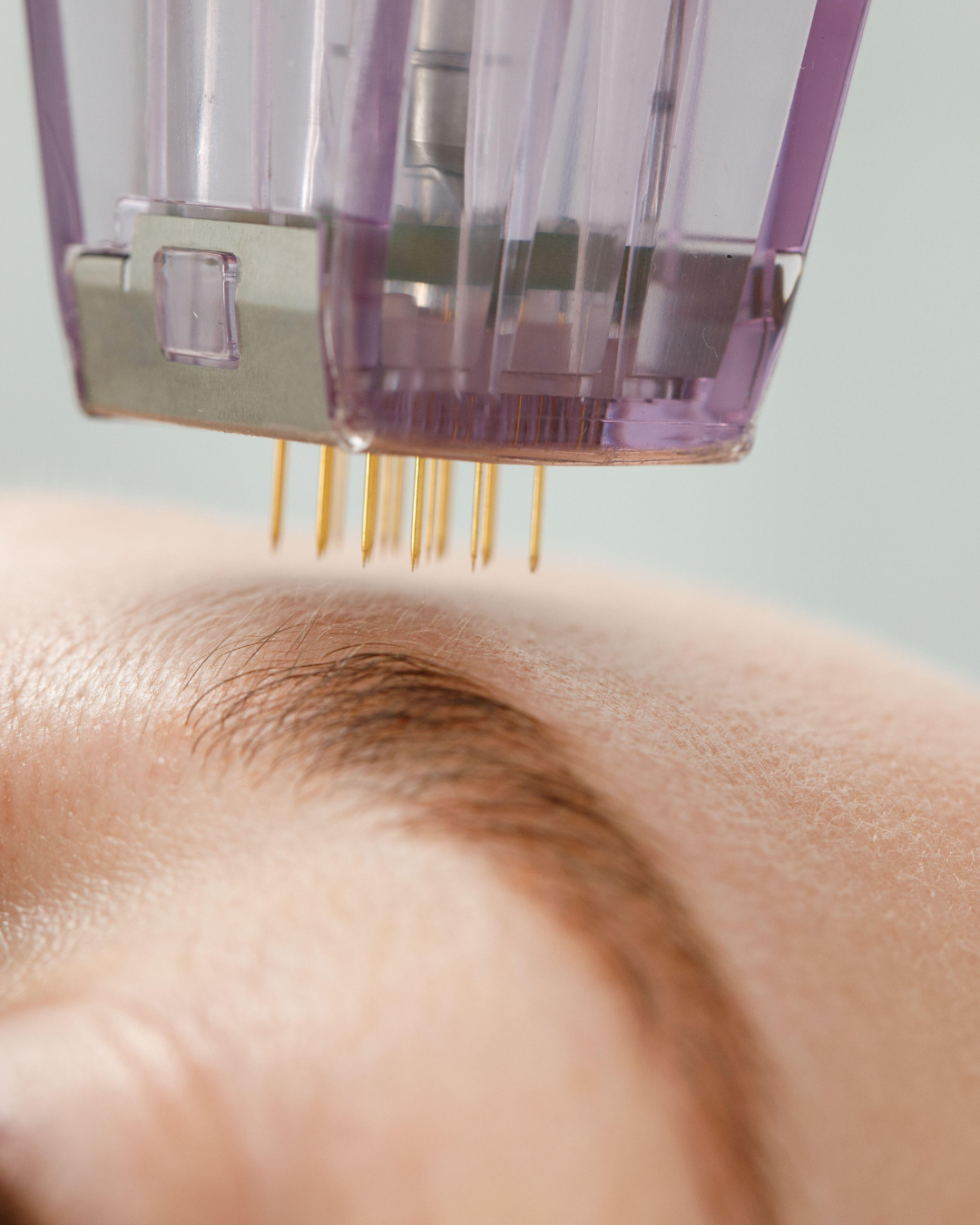 Morpheus8 Treatment in Denver: What You Should Know Before Choosing a Provider