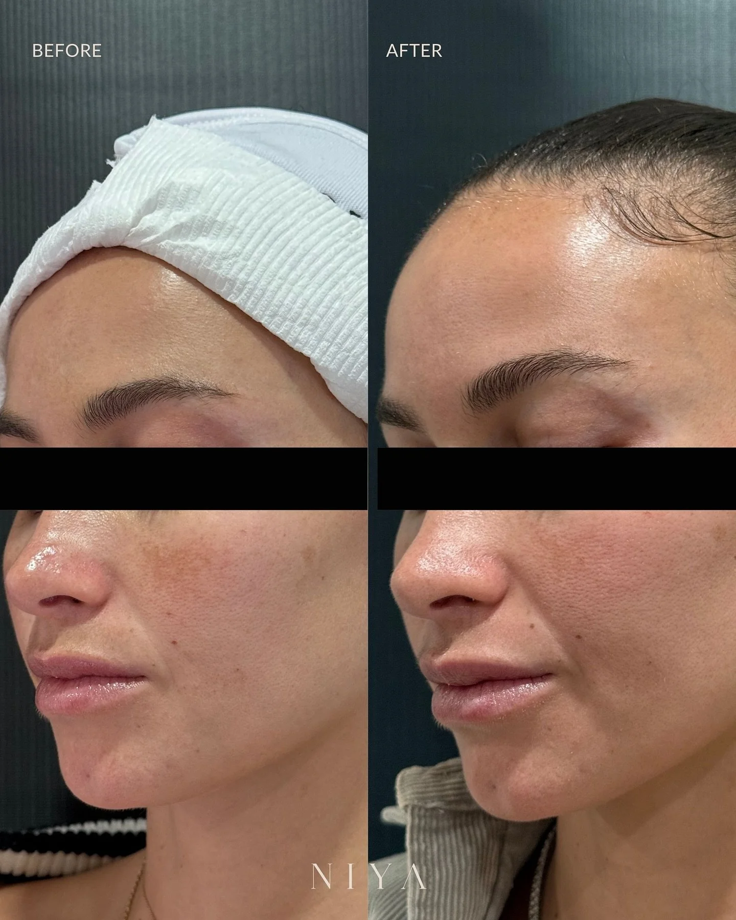 Real Results: Brighter, Clearer Skin

Our Seaweed Peel is one of the most effective treatments for stubborn pigmentation, including melasma and sun damage.

This client wanted to target discoloration on her cheeks and upper lip, and after just one pe