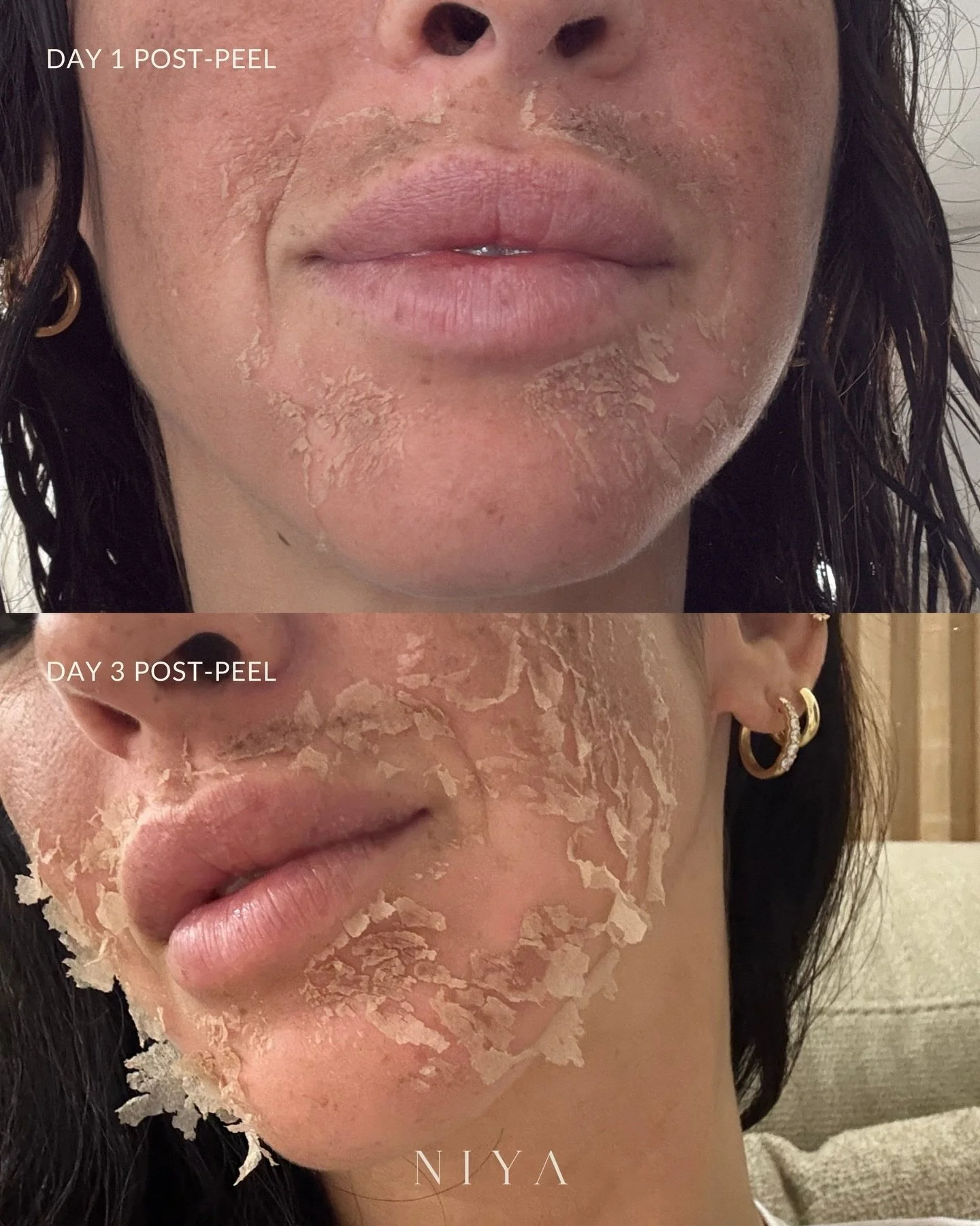 Our client came to us struggling with melasma from prolonged sun exposure, with noticeable discoloration along the upper lip and cheeks.

Swipe for her Day 5 post-Seaweed Peel and yes, she&rsquo;s still peeling (and will continue to!) because this tr