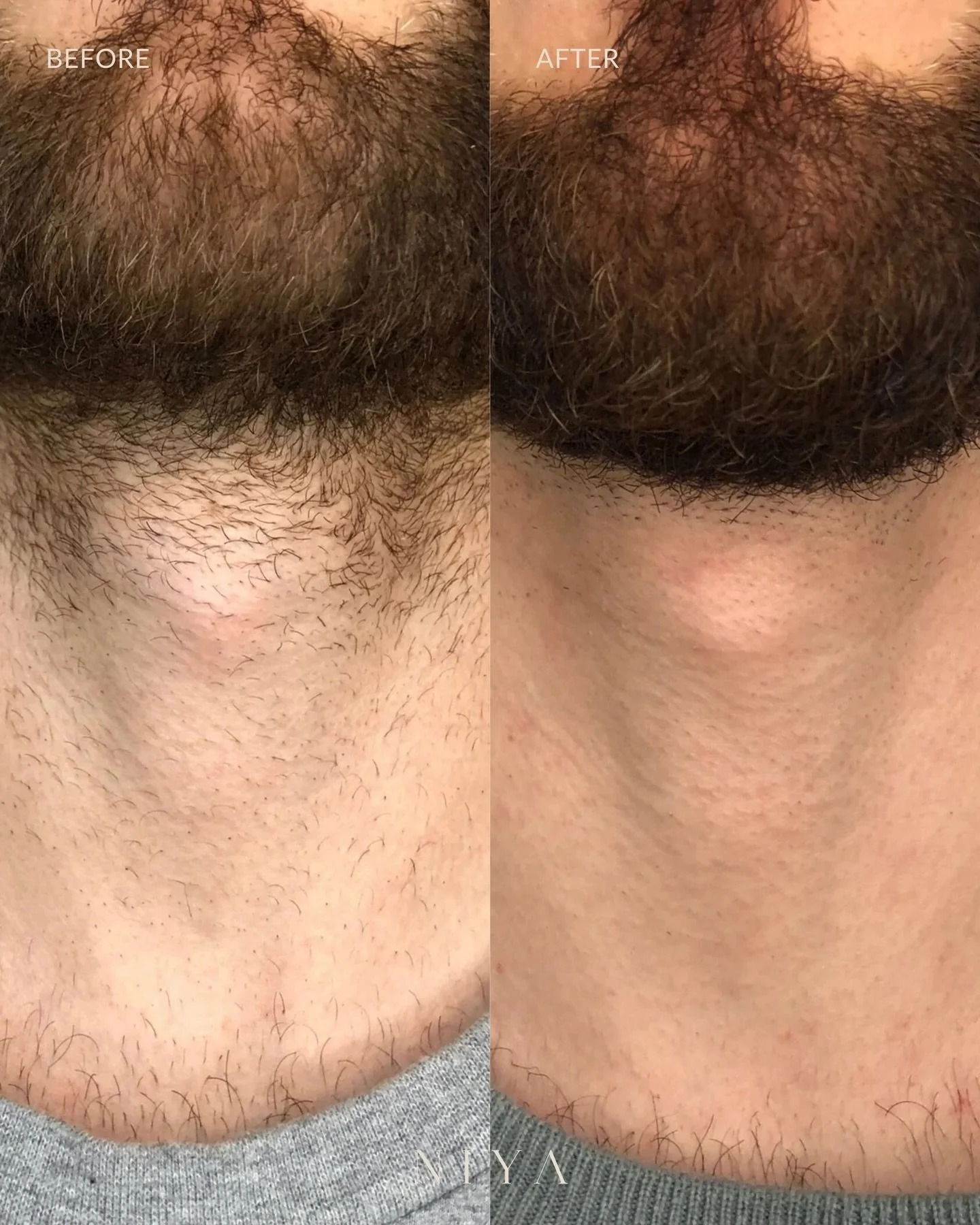 Men: it&rsquo;s your turn. For a limited time, our Beard Treatment Package is now $600 for 6 sessions (regularly $750).

This treatment helps:
&bull; Prevent ingrown hairs
&bull; Reduce irritation + razor bumps
&bull; Sharpen beard lines
&bull; Smoot