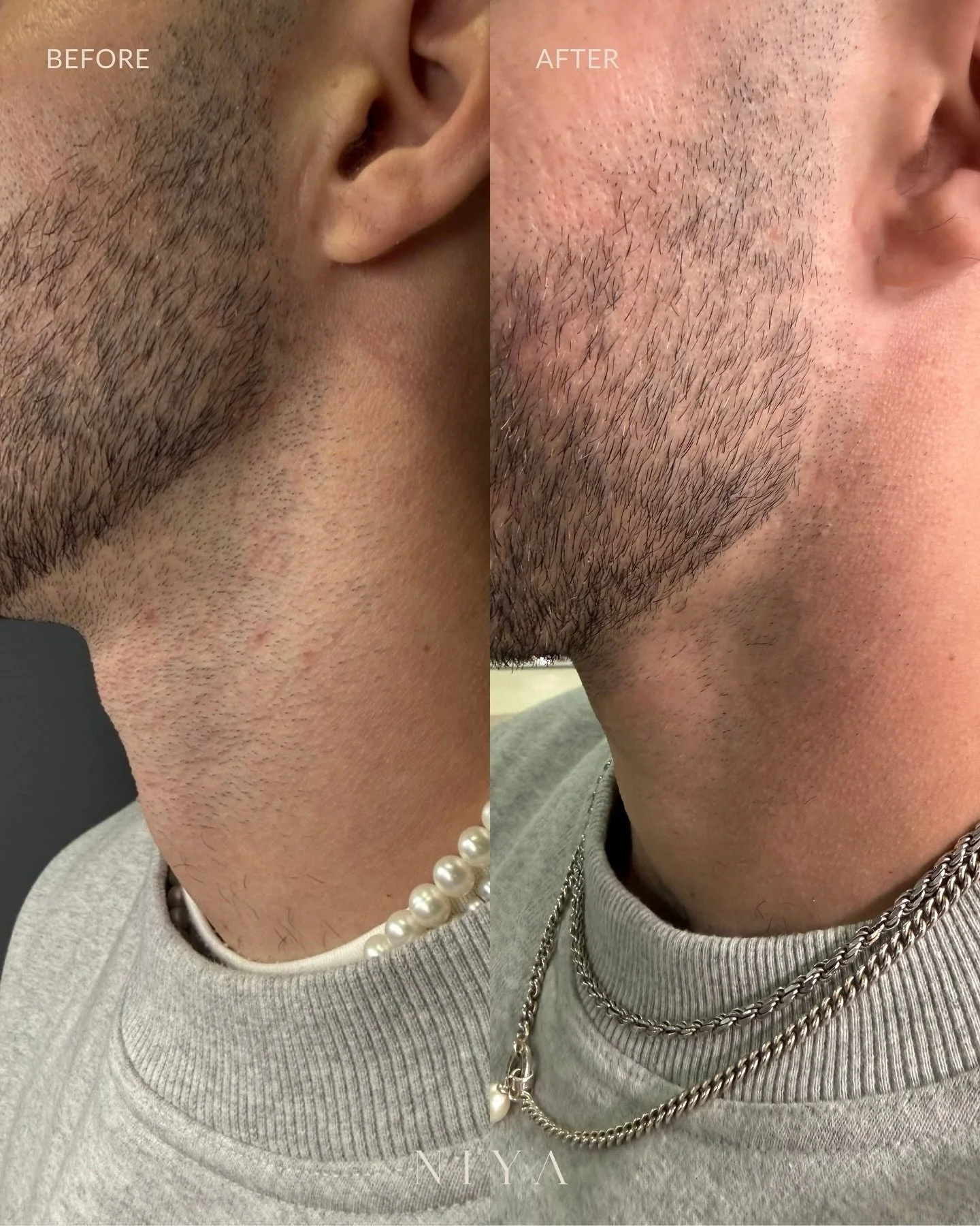 4 weeks later and the results speak for themselves. Less hair, no ingrowns, smoother skin, and a cleaner beard line, all from just one Beard Shaping (laser) session. Consistency = confidence. Book your beard shaping journey at NIYA.