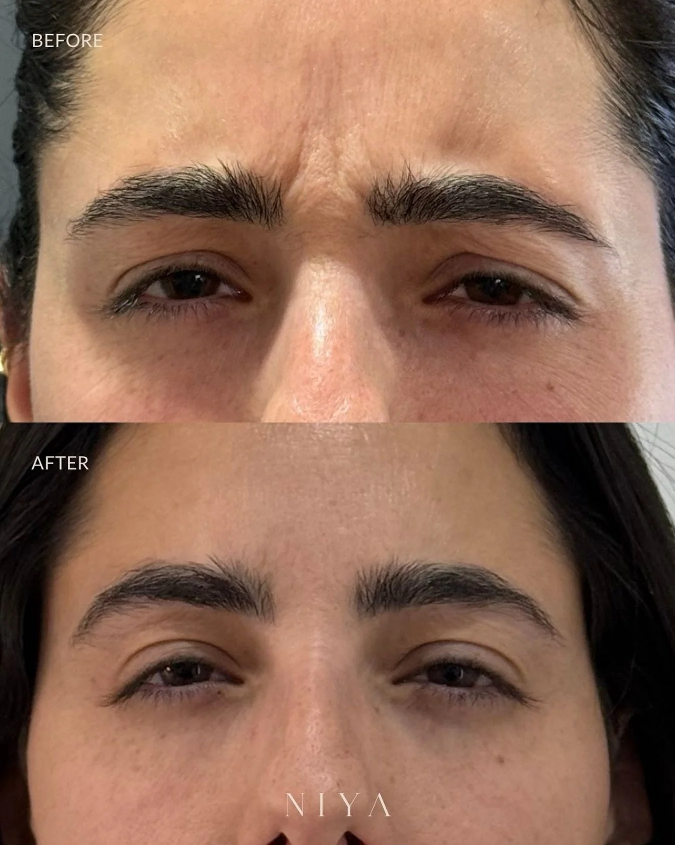 Subtle changes, lasting impact.

Botox softens frown lines by relaxing the underlying muscle, creating a smoother, more refreshed look while preserving natural expression.

Refined results, always. Book your complimentary consultation now at 305.605.