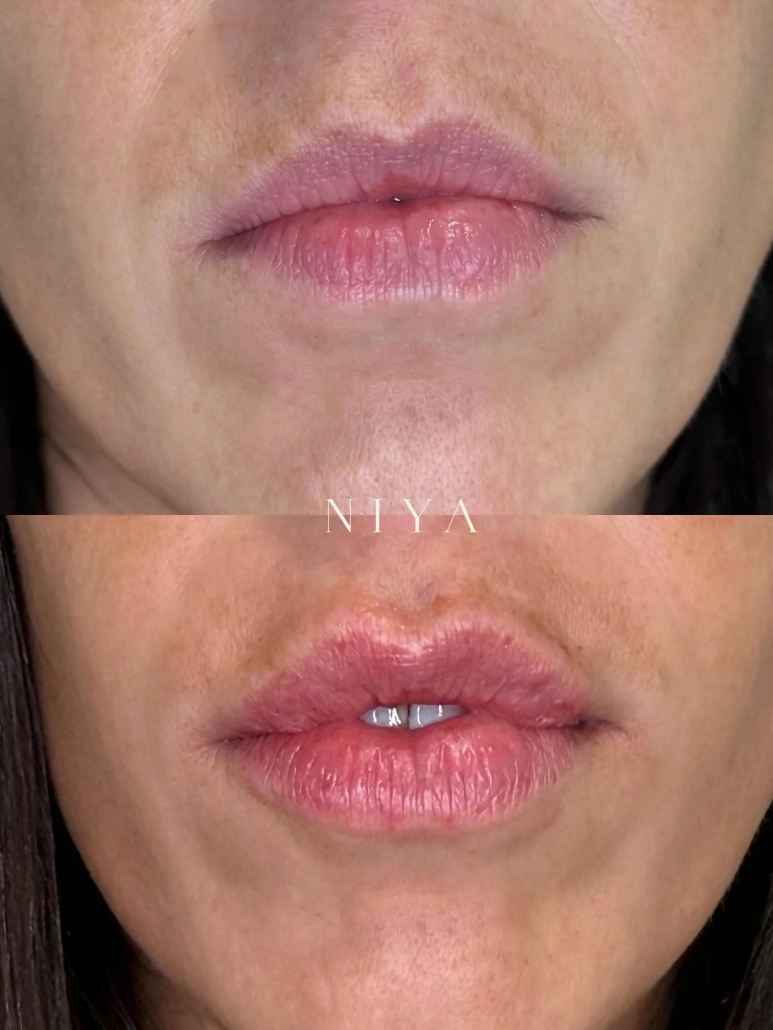 A subtle enhancement can make all the difference. ✨

Balanced shape, natural-looking volume, and lips that still look like you, just refreshed.

Ready for your own lip refresh? Book your appointment at NIYA.

#NIYAMiami #LipFiller #BeforeAndAfter