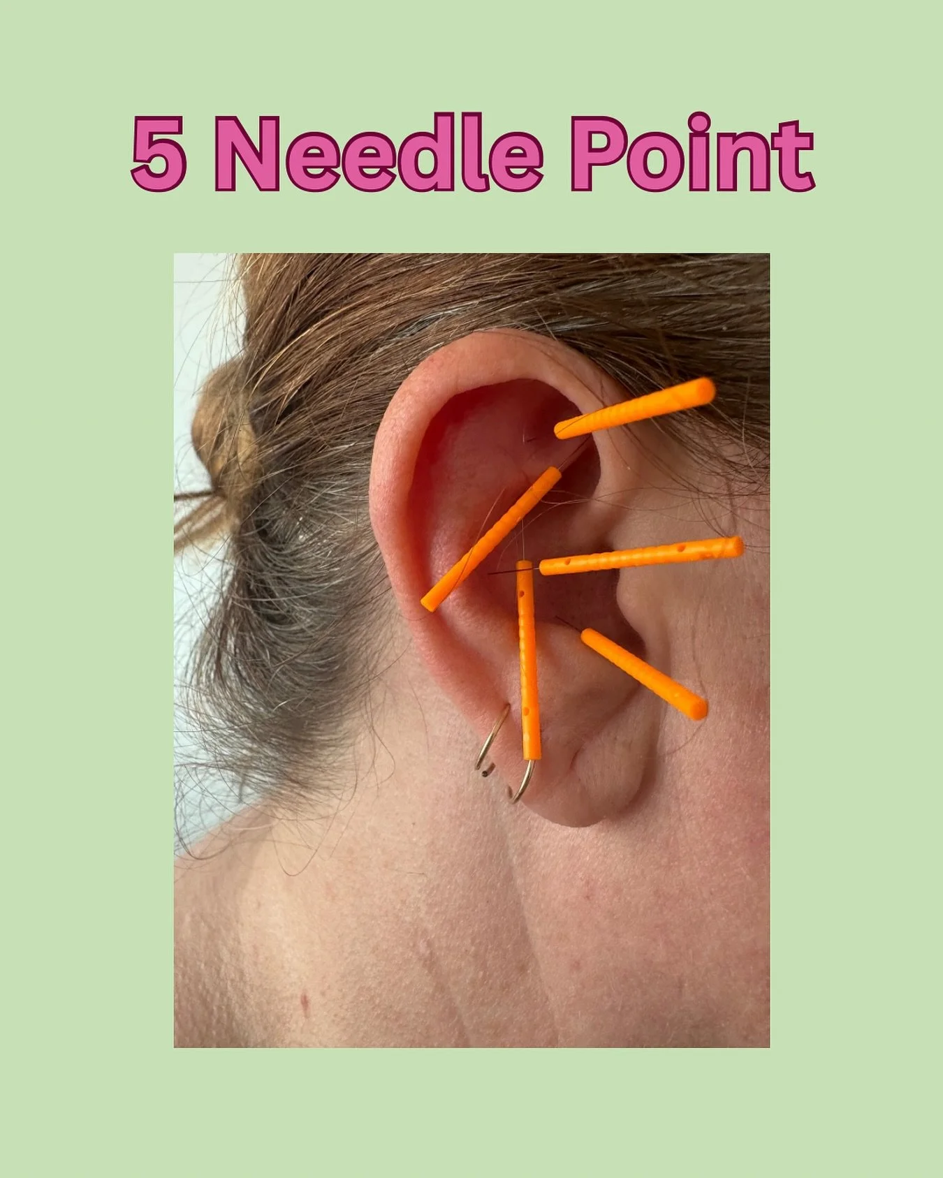 Shoutout to our dear friend Lisa @realwelltherapy who let me poke her with needles this evening! 

Ear acupuncture coming soon 😉